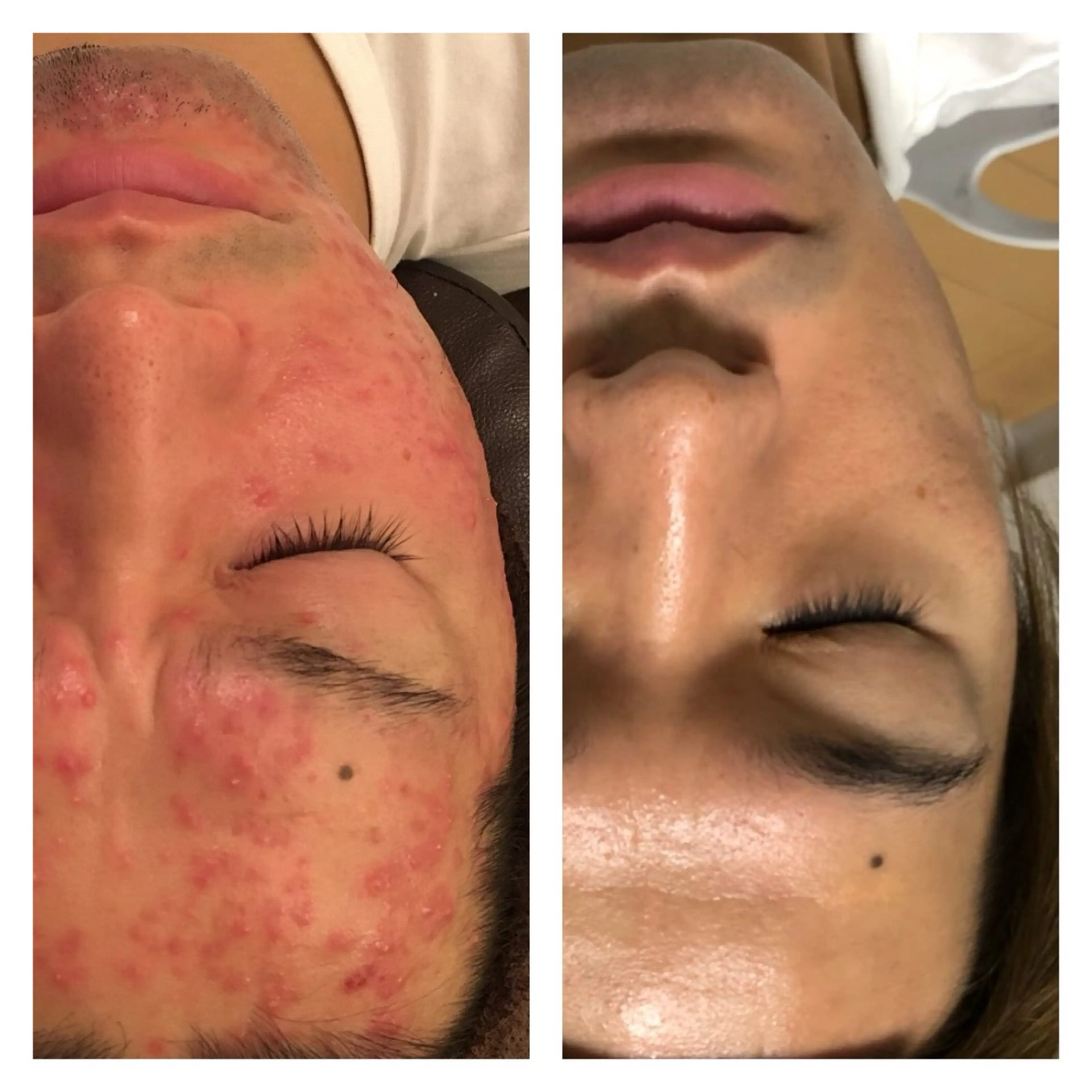 【赤ニキビ改善】 BELL'ET新宿店のエステ・リラクイメージ