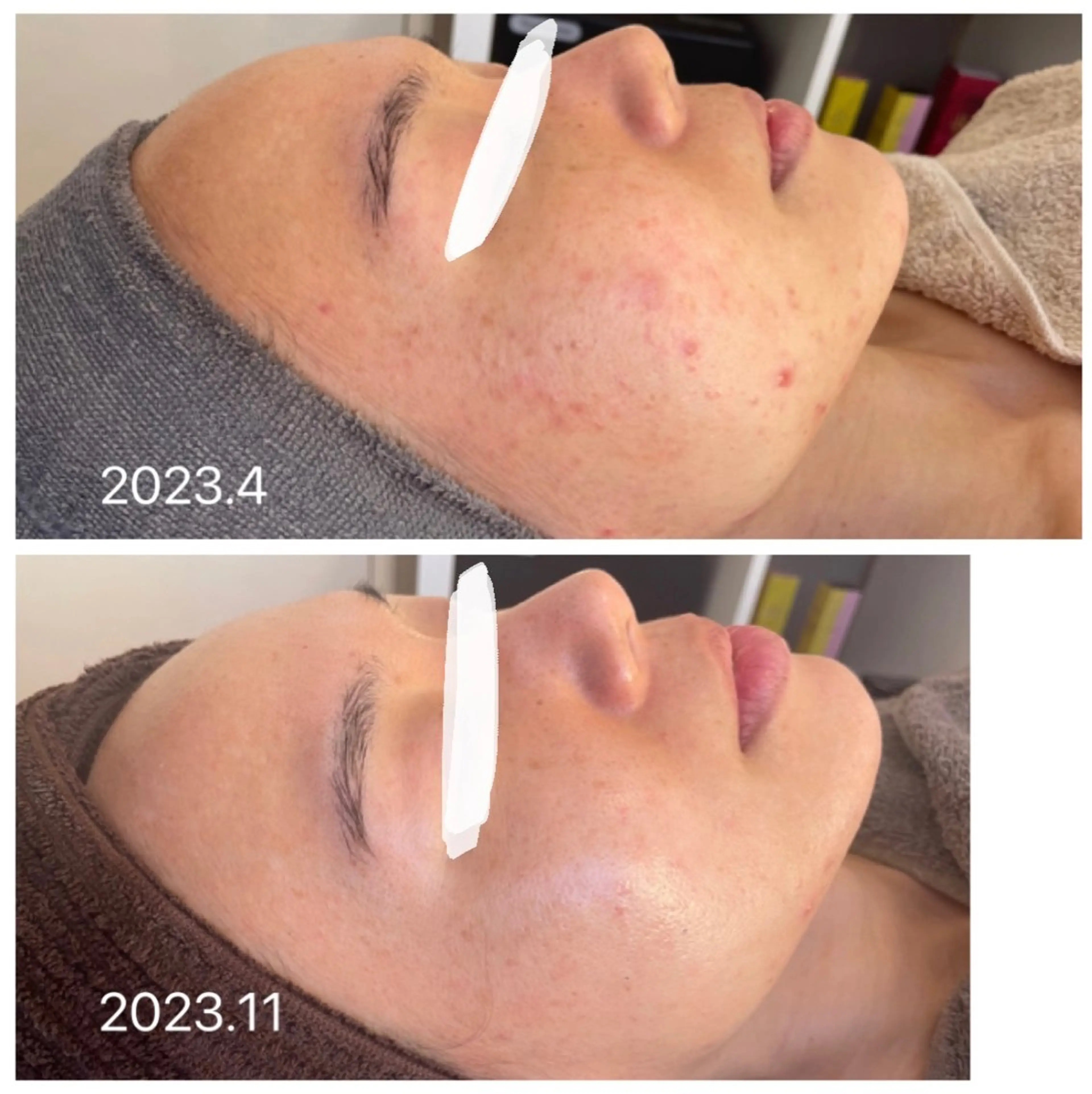 【大人ニキビを撃退してツヤ肌に✨】陶肌トリートメント(剥離なしハーブピーリング)+オプション🎁スキンケア半顔体験付の写真