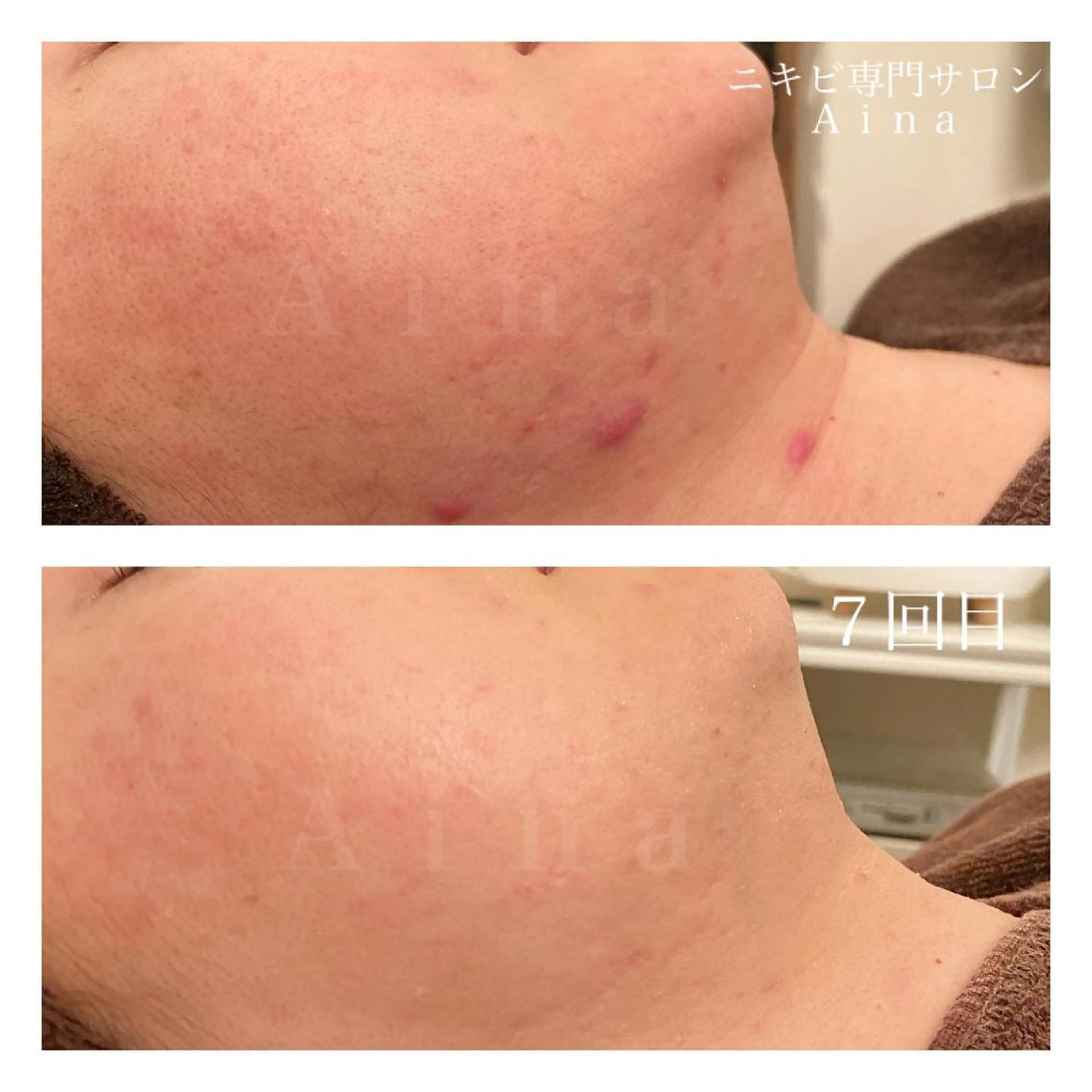 ロング カラー パーマ ヘアアレンジ メンズ キッズ ネイル マツエク・マツパ 結婚式・ブライダル 結婚式・ブライダル ブライダルネイル エステ リラク ニキビ跡専門サロン Ainaのエステ・リラクイメージ