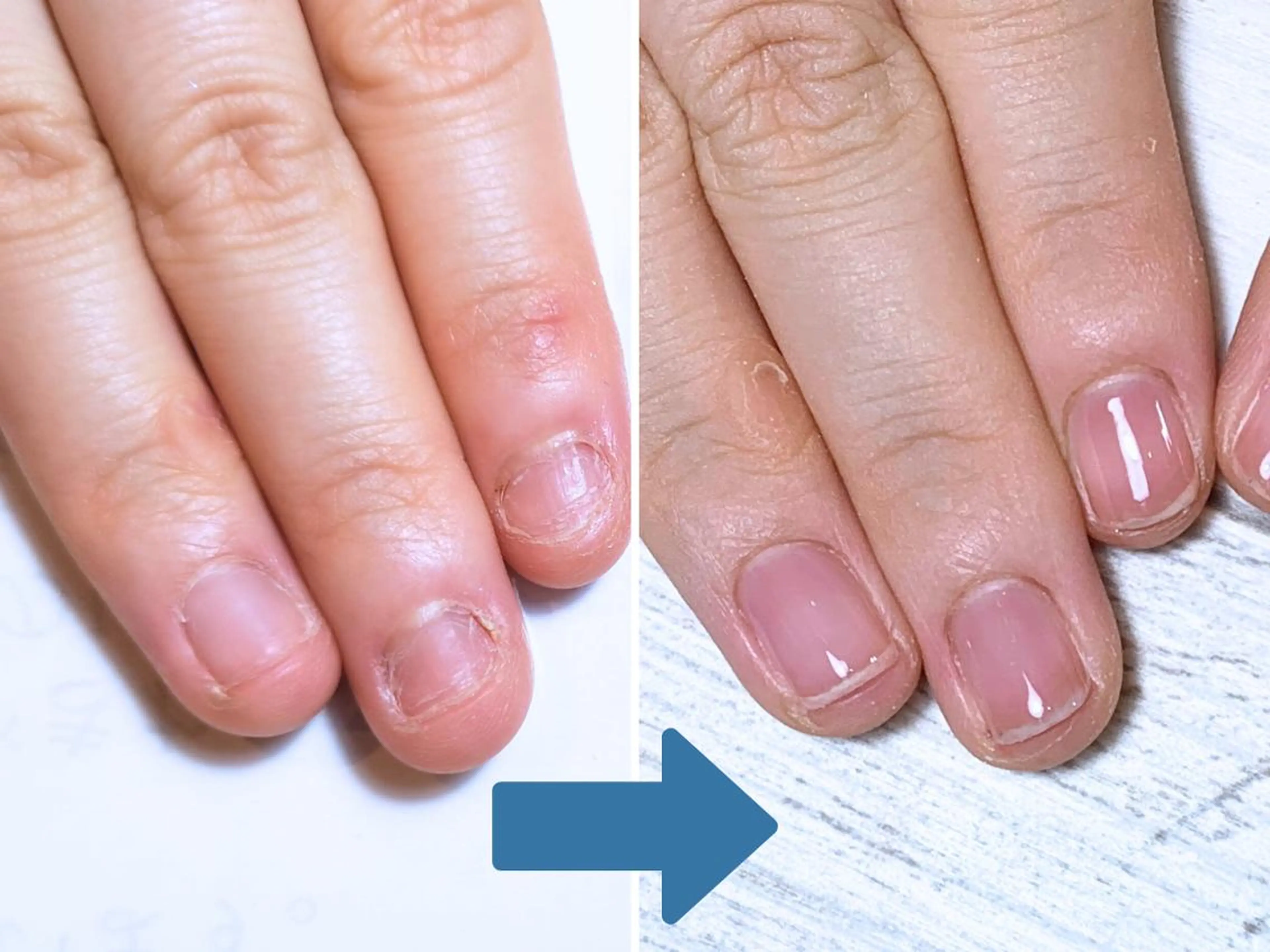 ネイル 深爪矯正・自爪育成 ネイルサロンアモまいのネイルデザイン