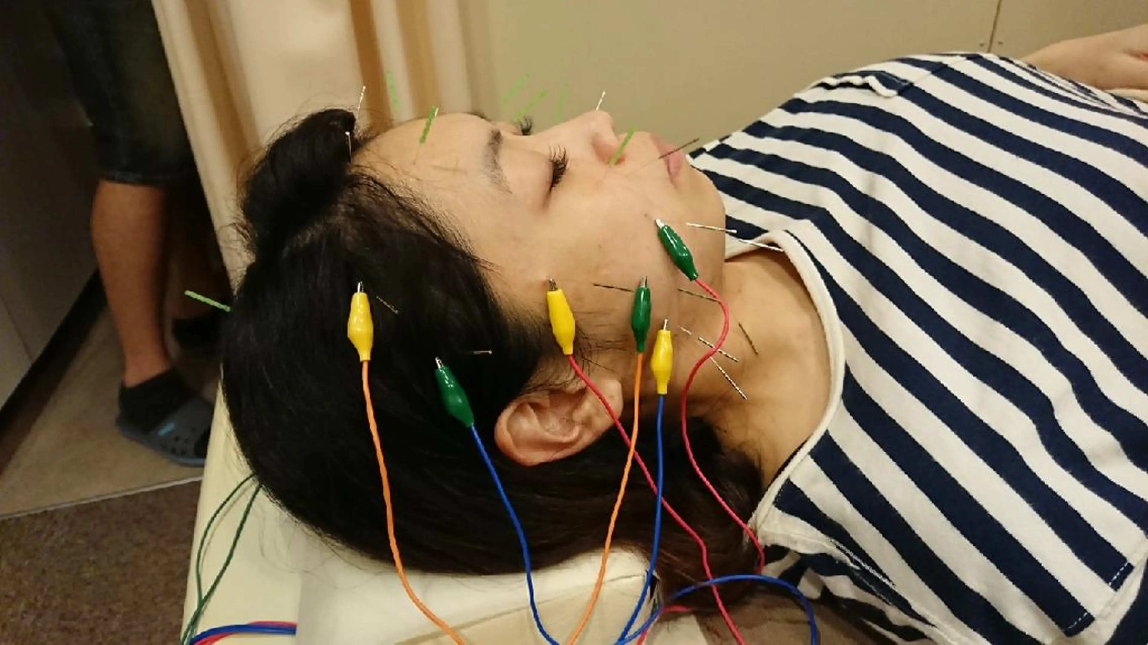【お顔悩みも身体の不調も一緒に解消したい】電気を流す美容鍼+身体の鍼灸(主に背中・首・肩の施術)の写真