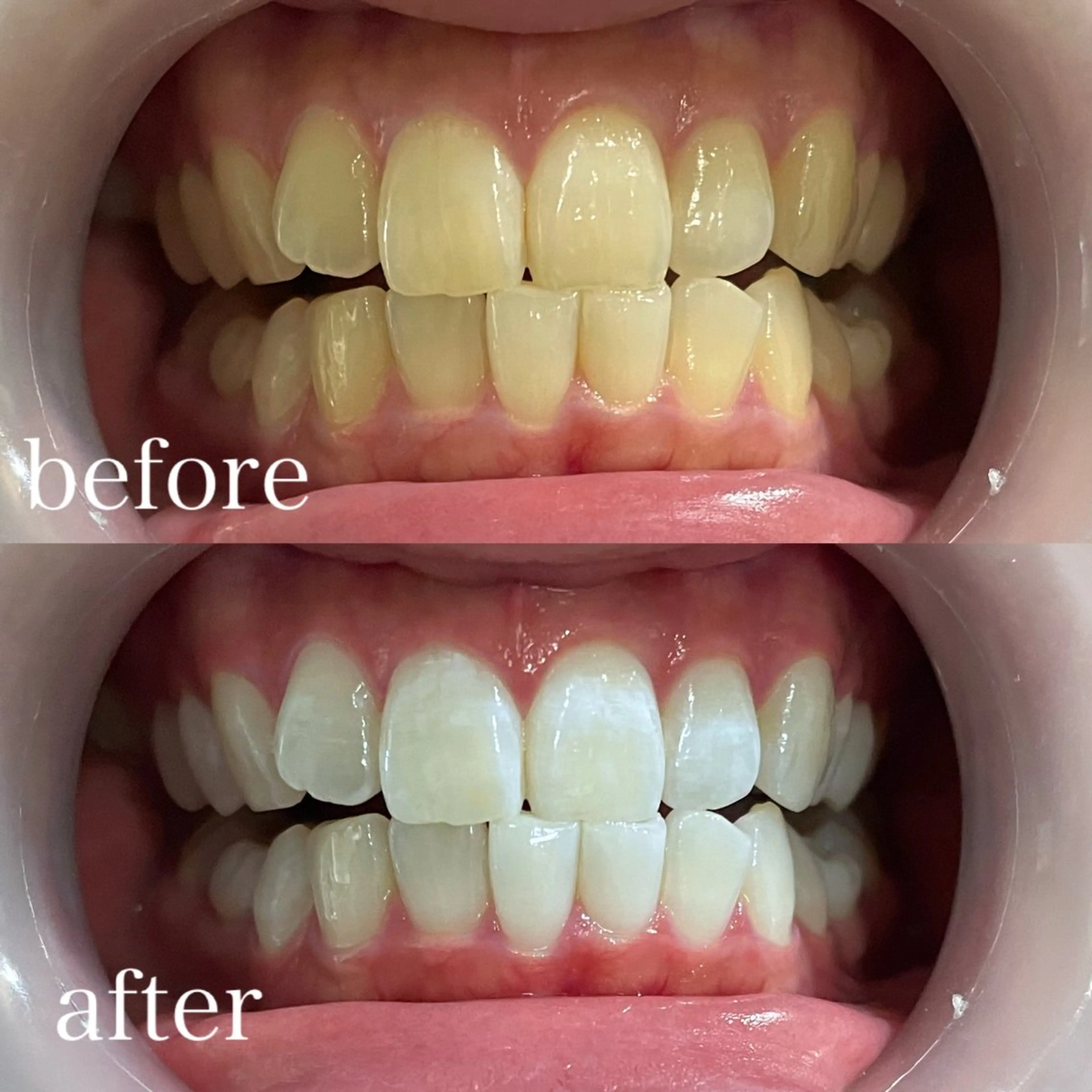 🦷✨ちゃんと白くしたい方✨🦷本格医療提携ホワイトニング【通常¥12100→初回¥4500❤️‍🔥】今だけ限定価格の写真