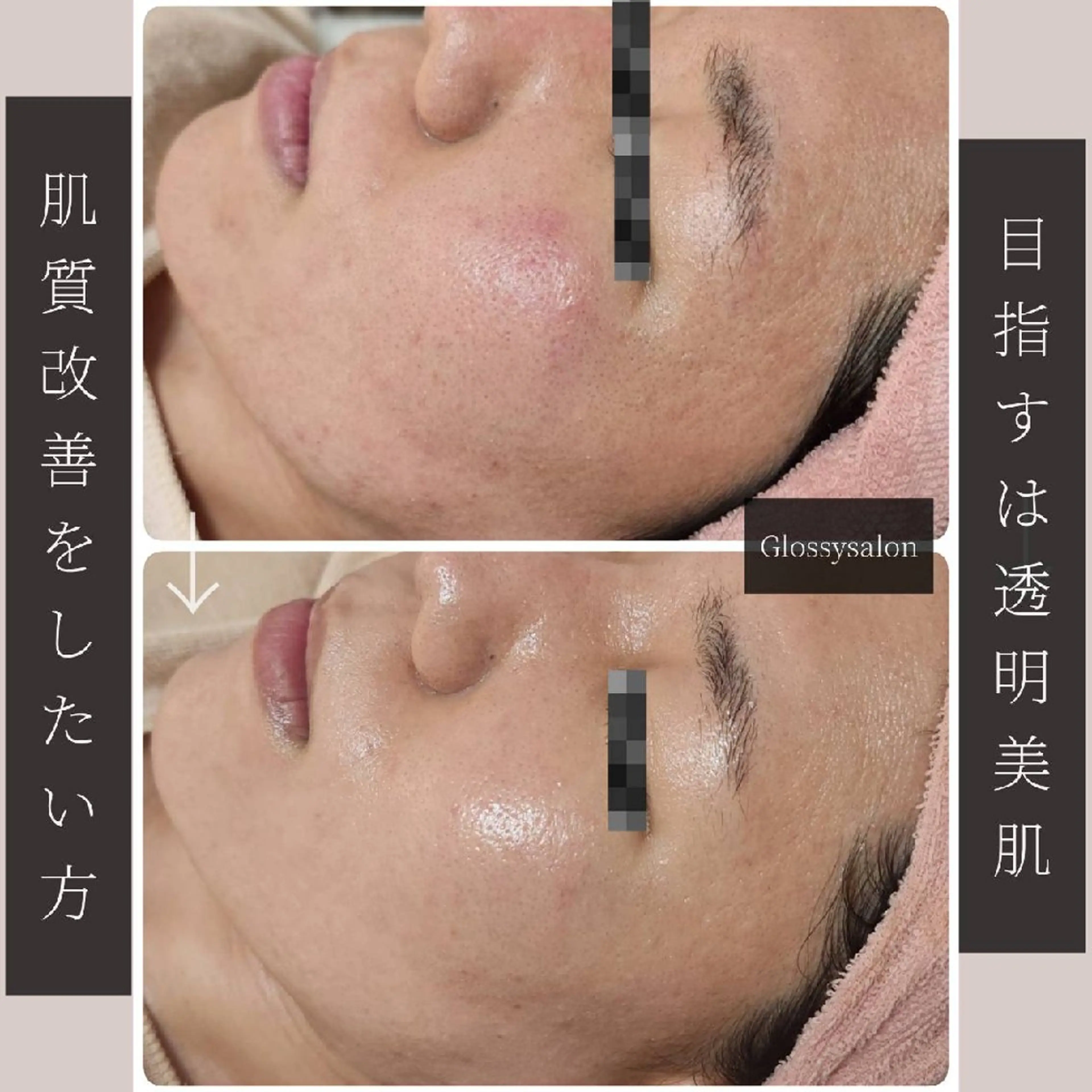 【ミニモ限定モニター募集】ハーブピーリング3回券の写真