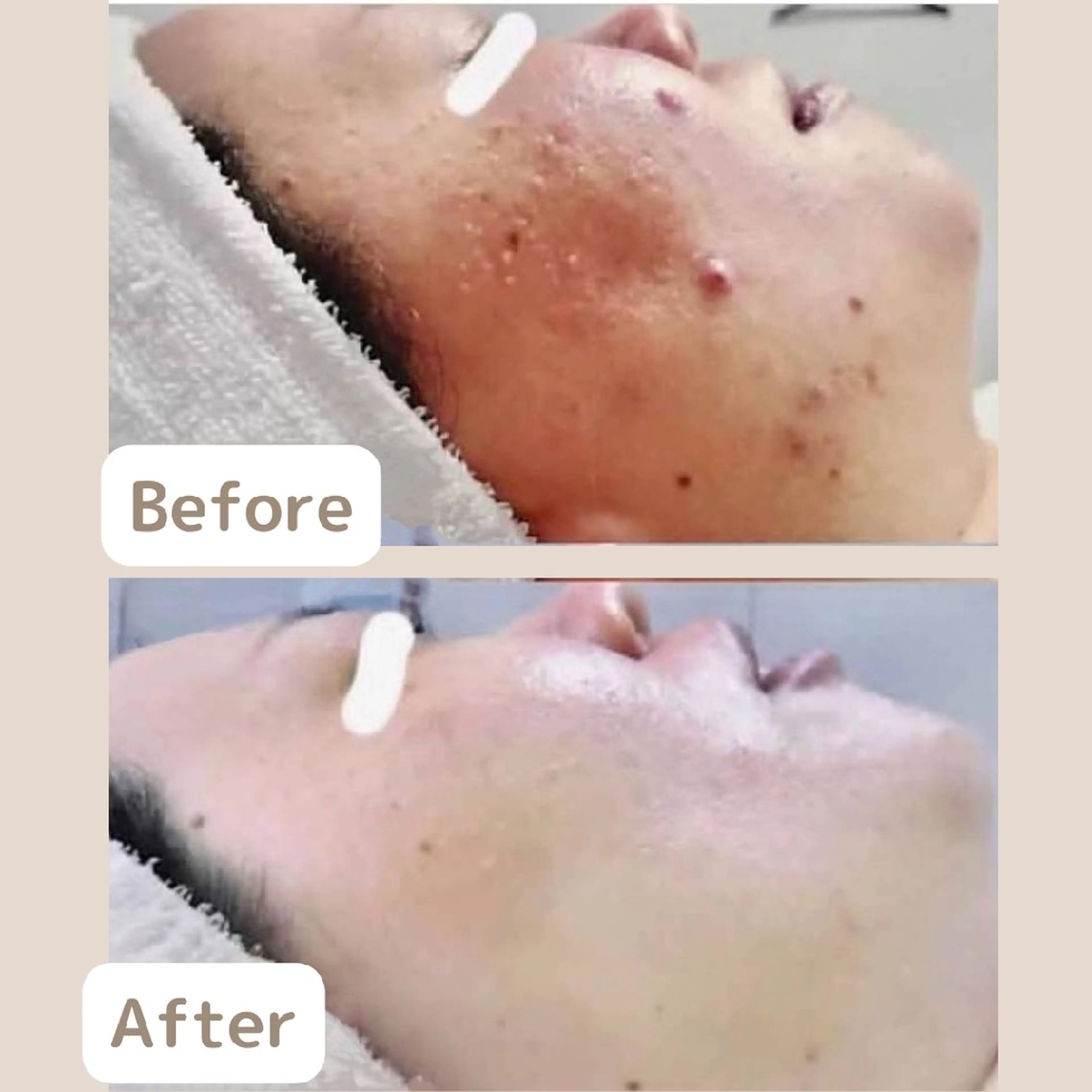 〈ニキビケアサロン〉 レゾン京橋店/ 浅川のエステ・リラクイメージ