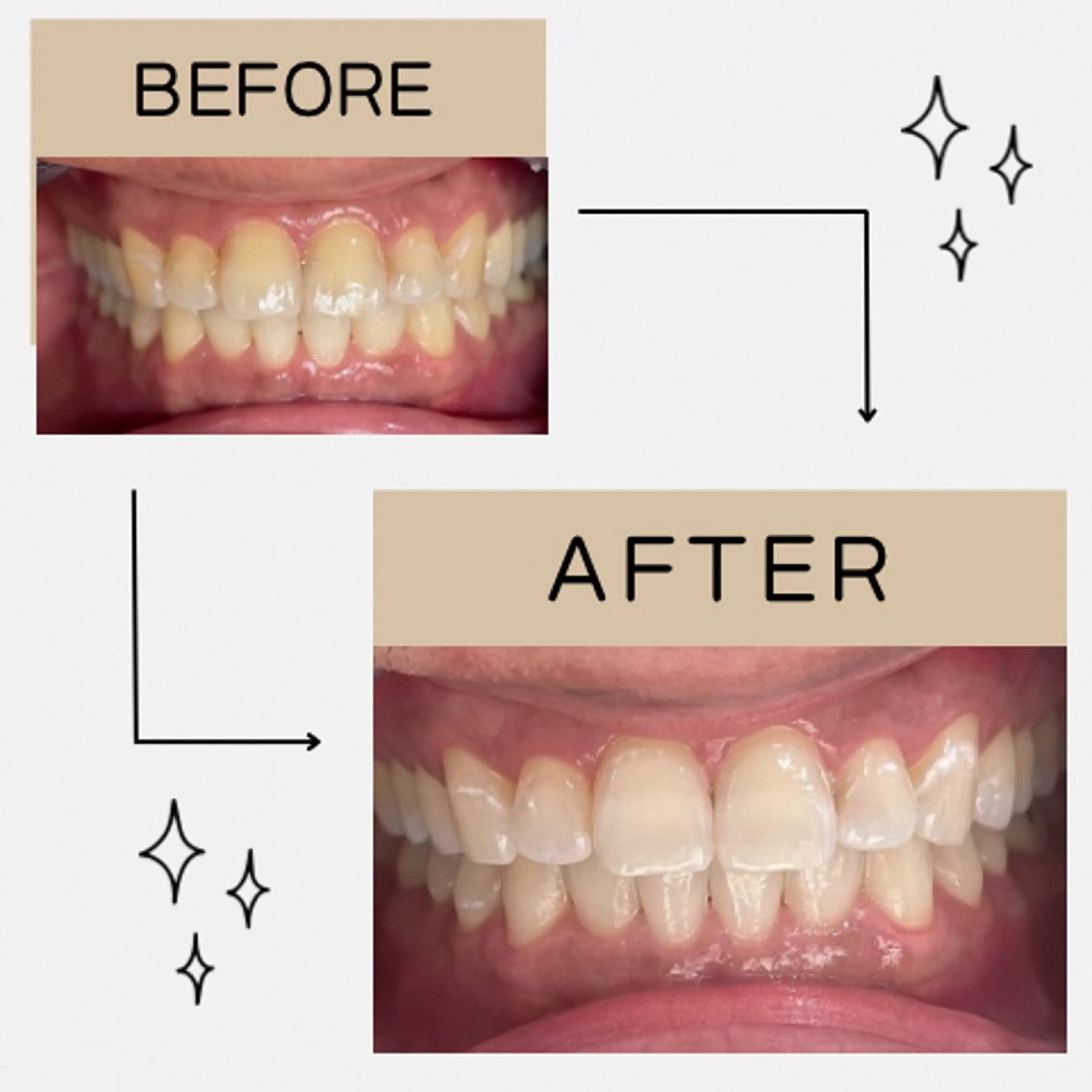 その他 サクッとホワイト都立大学店所属・セルフホワイトニング 都立大学🦷✴︎のその他イメージ