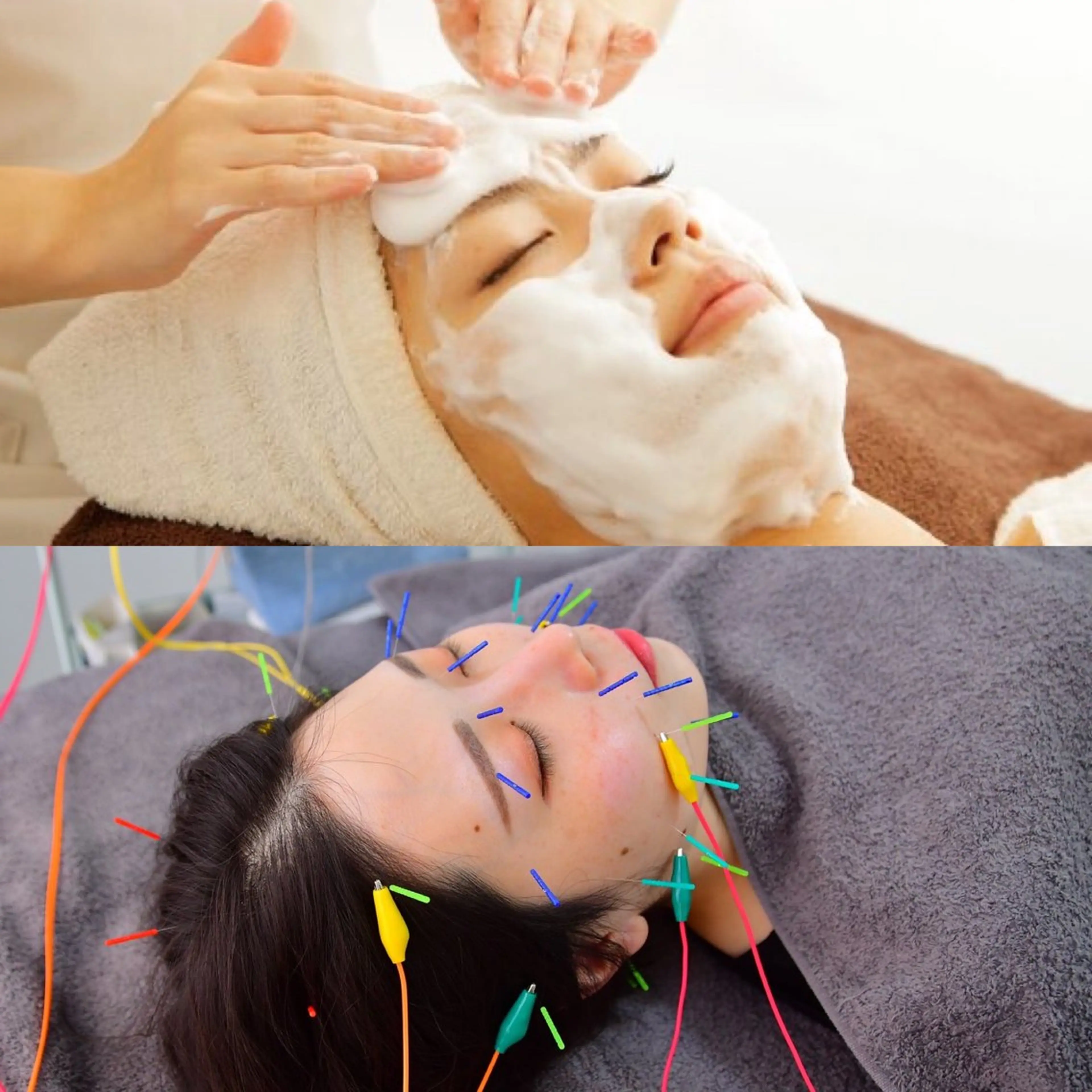 【ぷるん肌】炭酸パック×美容鍼 90分 ✨の写真