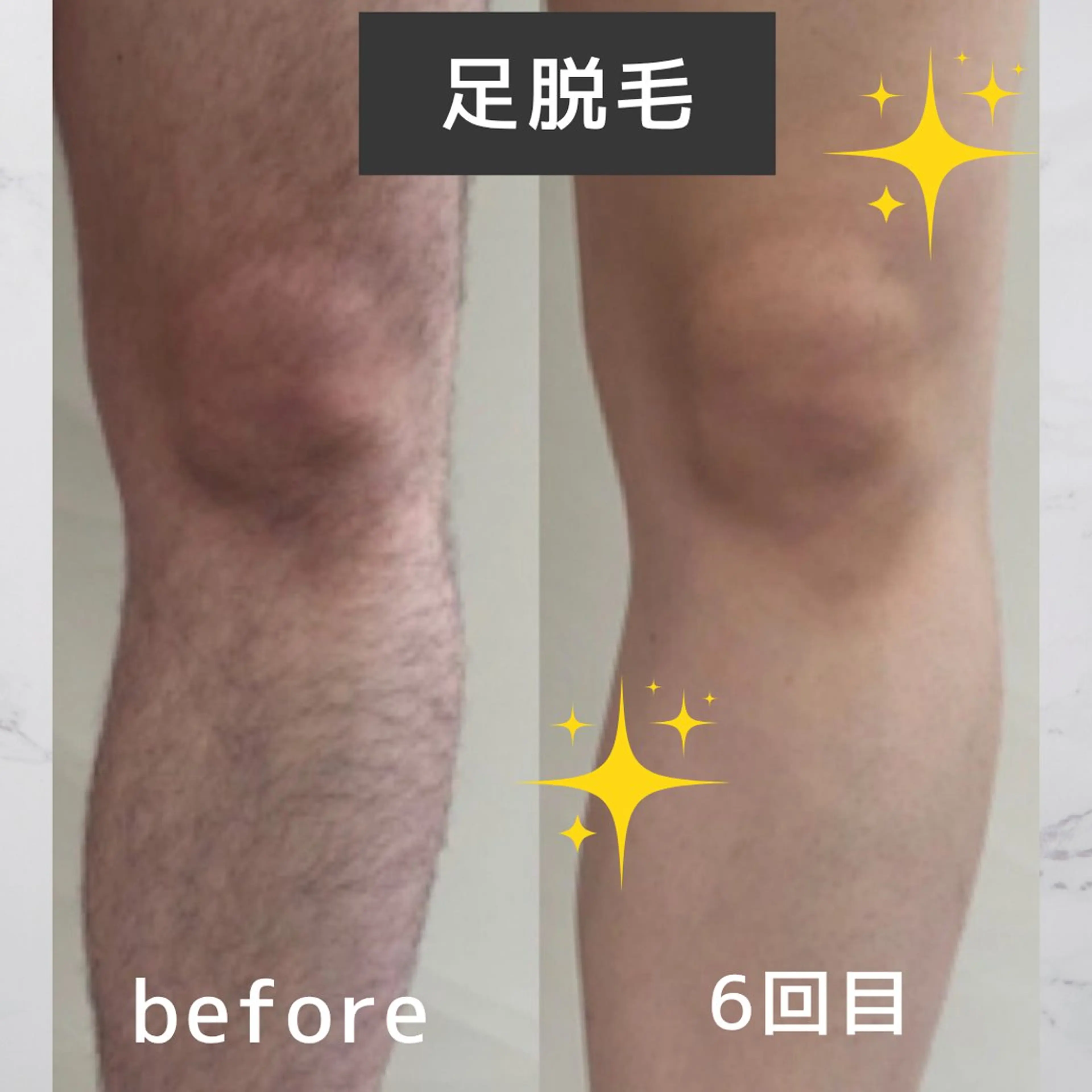 メンズ 脱毛 sourire スリールのエステ・リラクイメージ