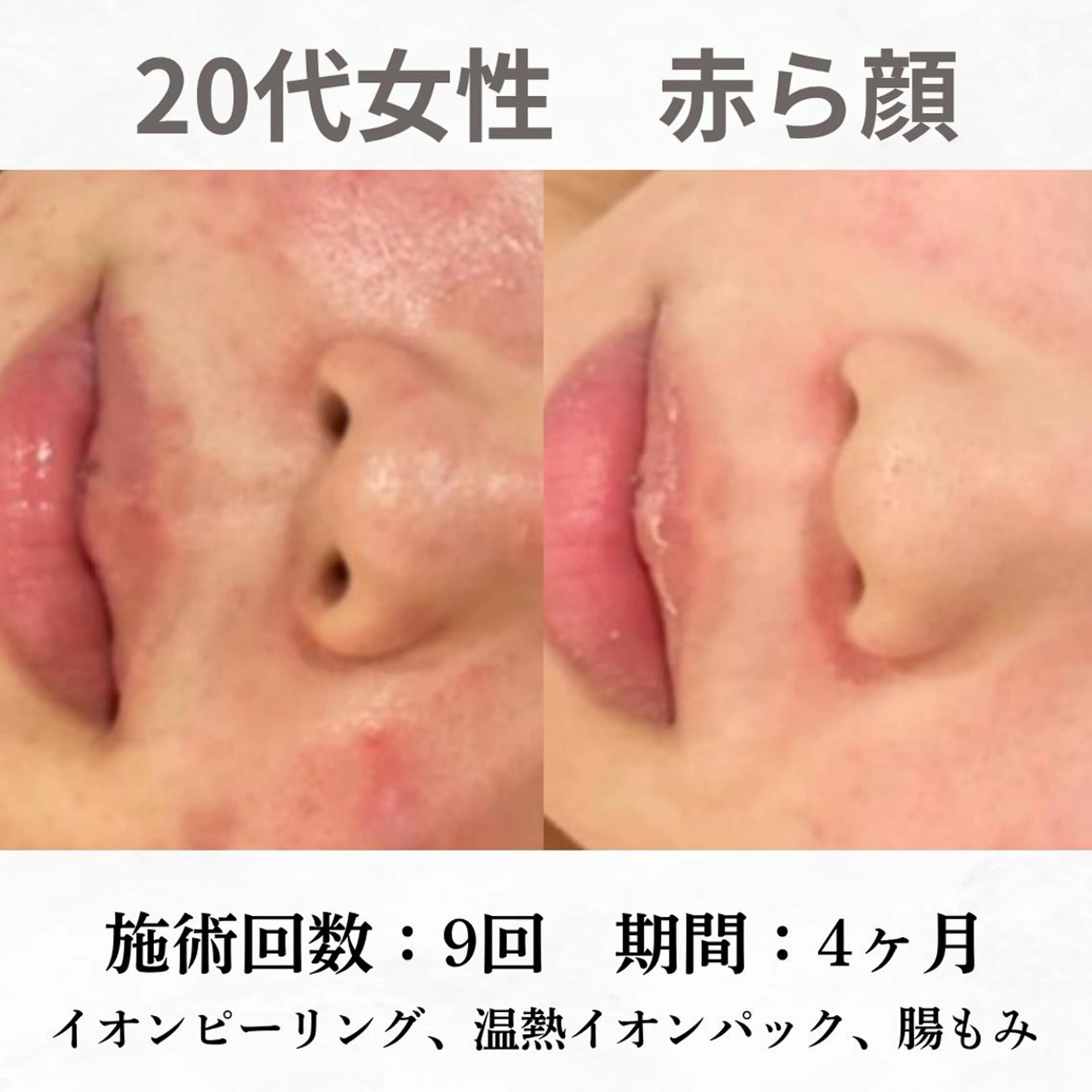 重度ニキビ専門🌷 ダウンタイムなしのエステ・リラクイメージ