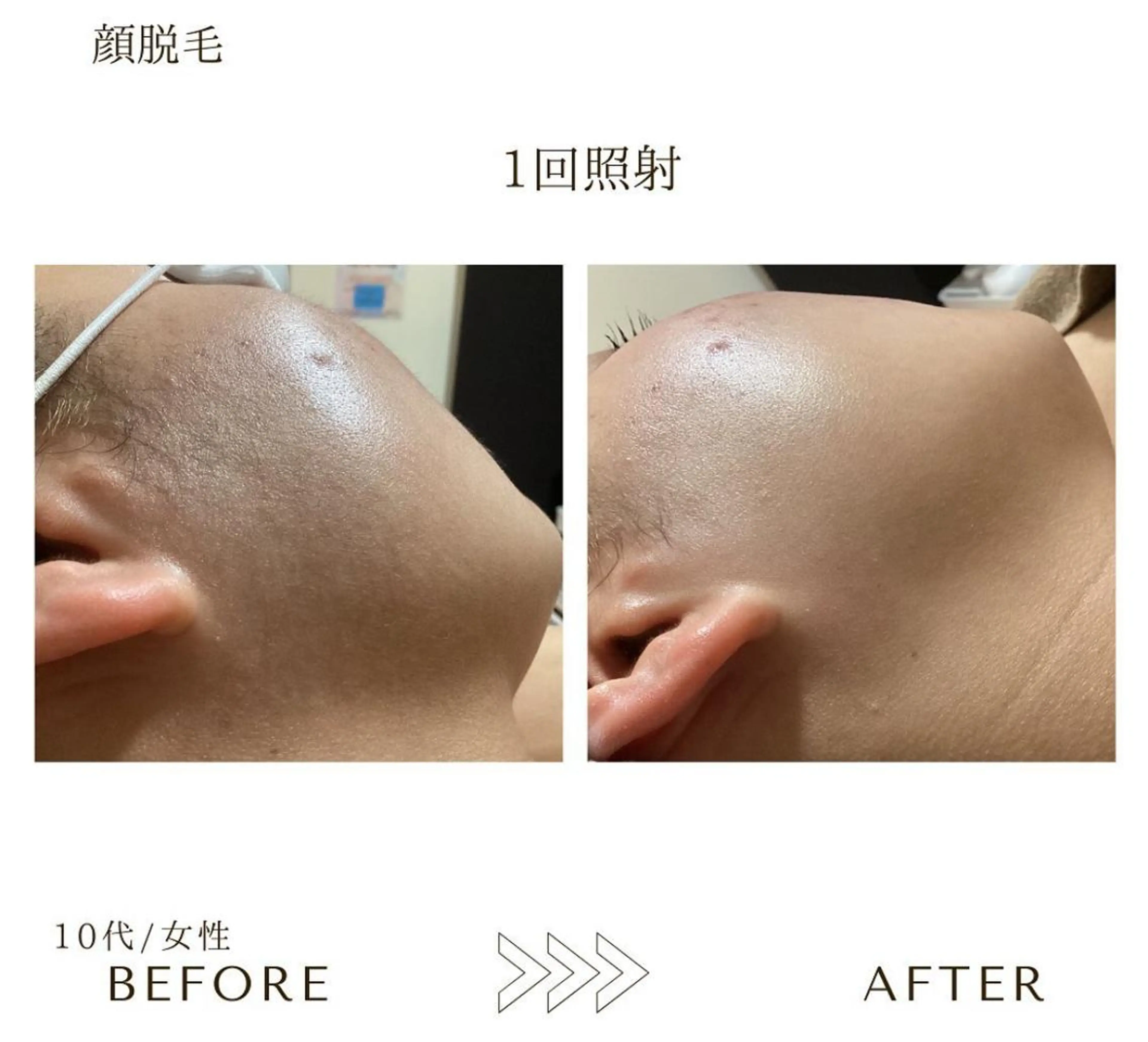 脱毛 本八幡salon83 ♡エイトミーのエステ・リラクイメージ