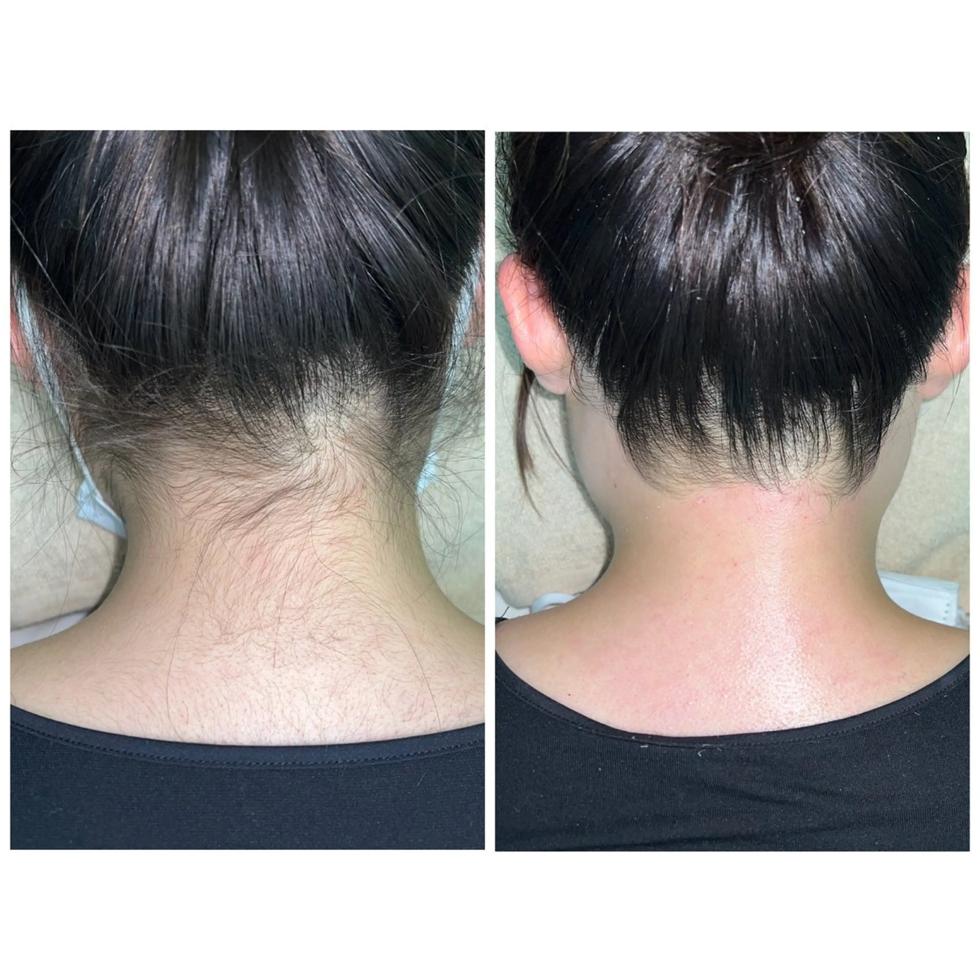 【学生から人気】うなじWAX（産毛・くすみケア）の写真