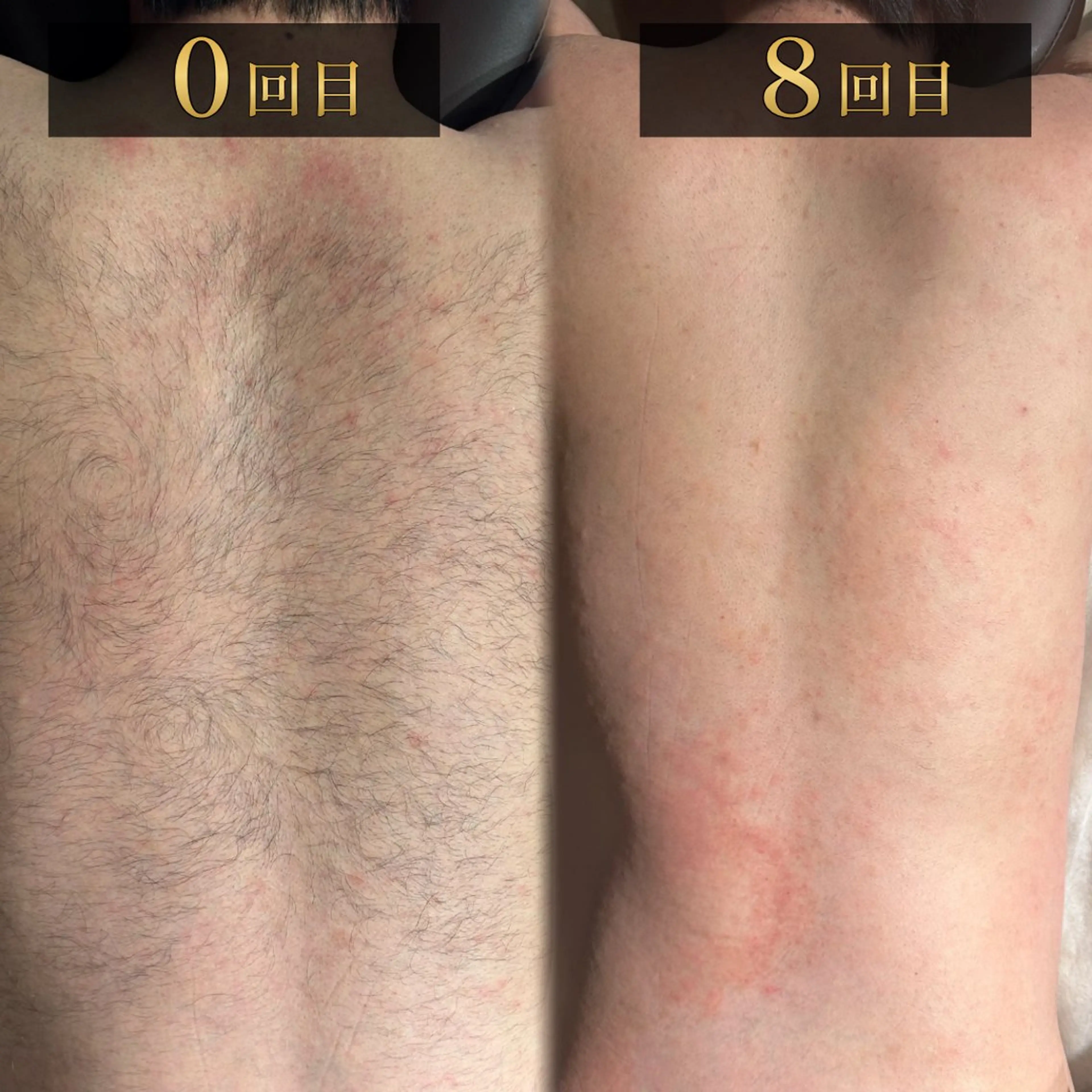 パーフェクト全身脱毛(ヒゲ込/vio無)の写真