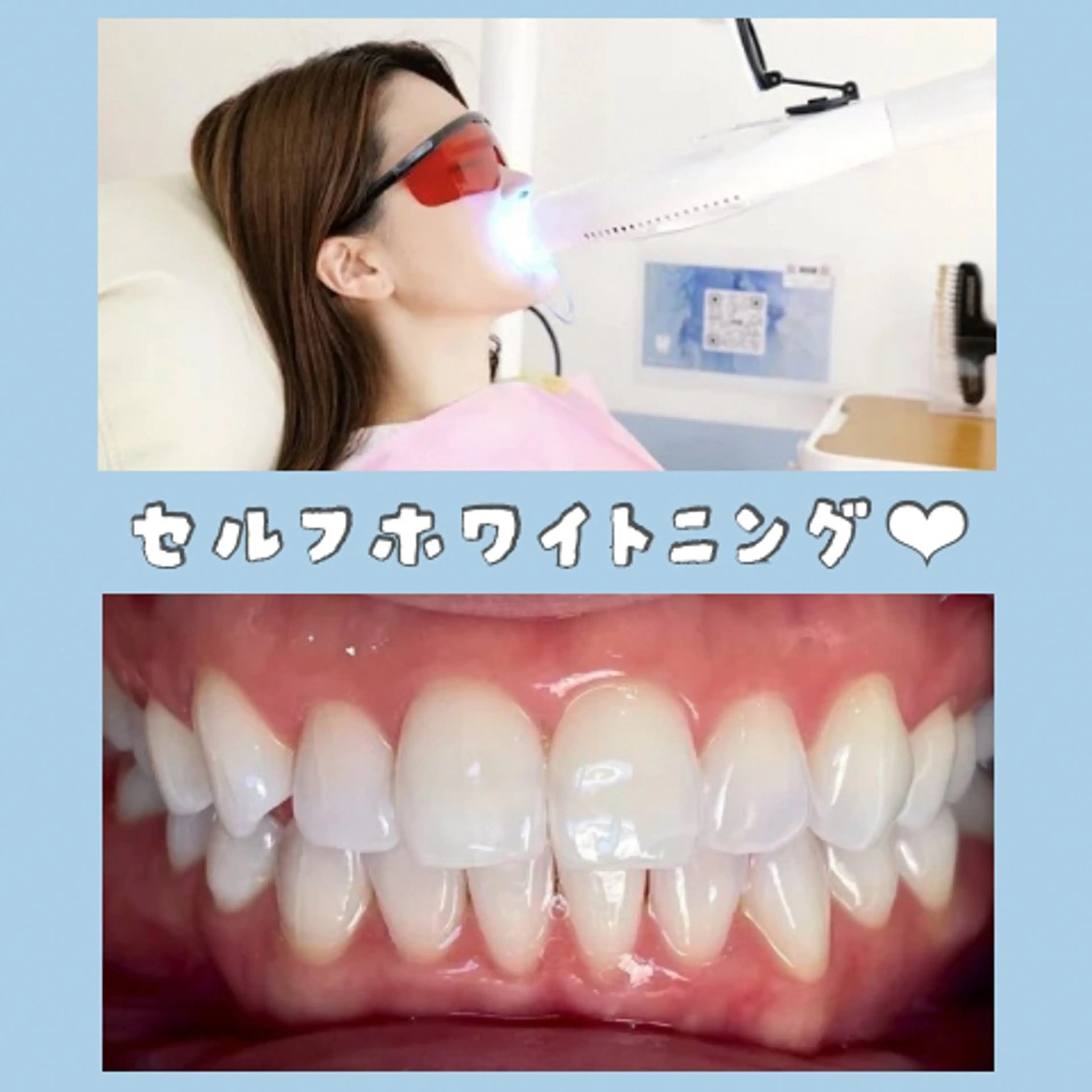 その他 セルフホワイトニング 都立大学🦷✴︎のその他イメージ