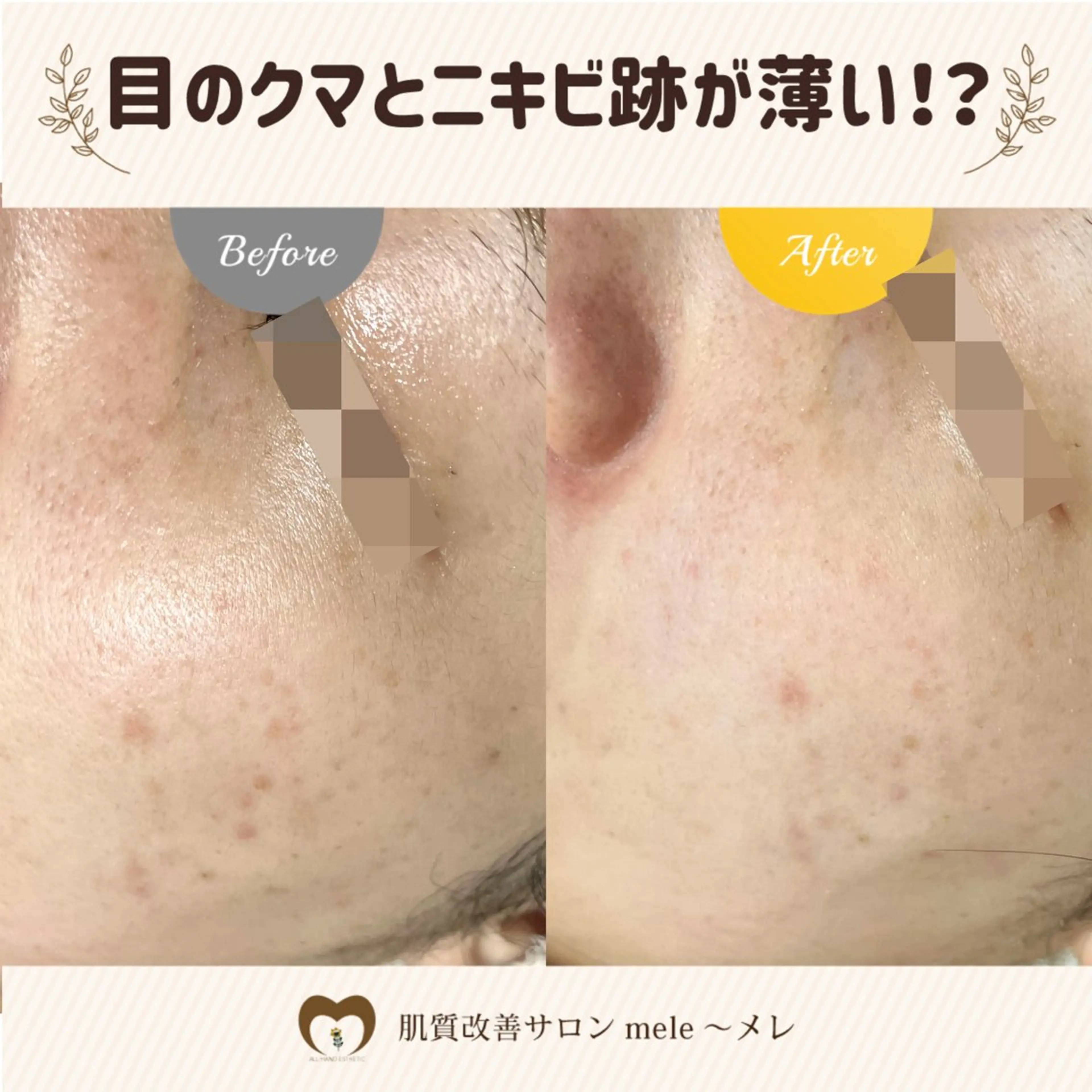 エステ リラク 繰り返すニキビ・毛穴 ✨つくば肌質改善専門のエステ・リラクイメージ