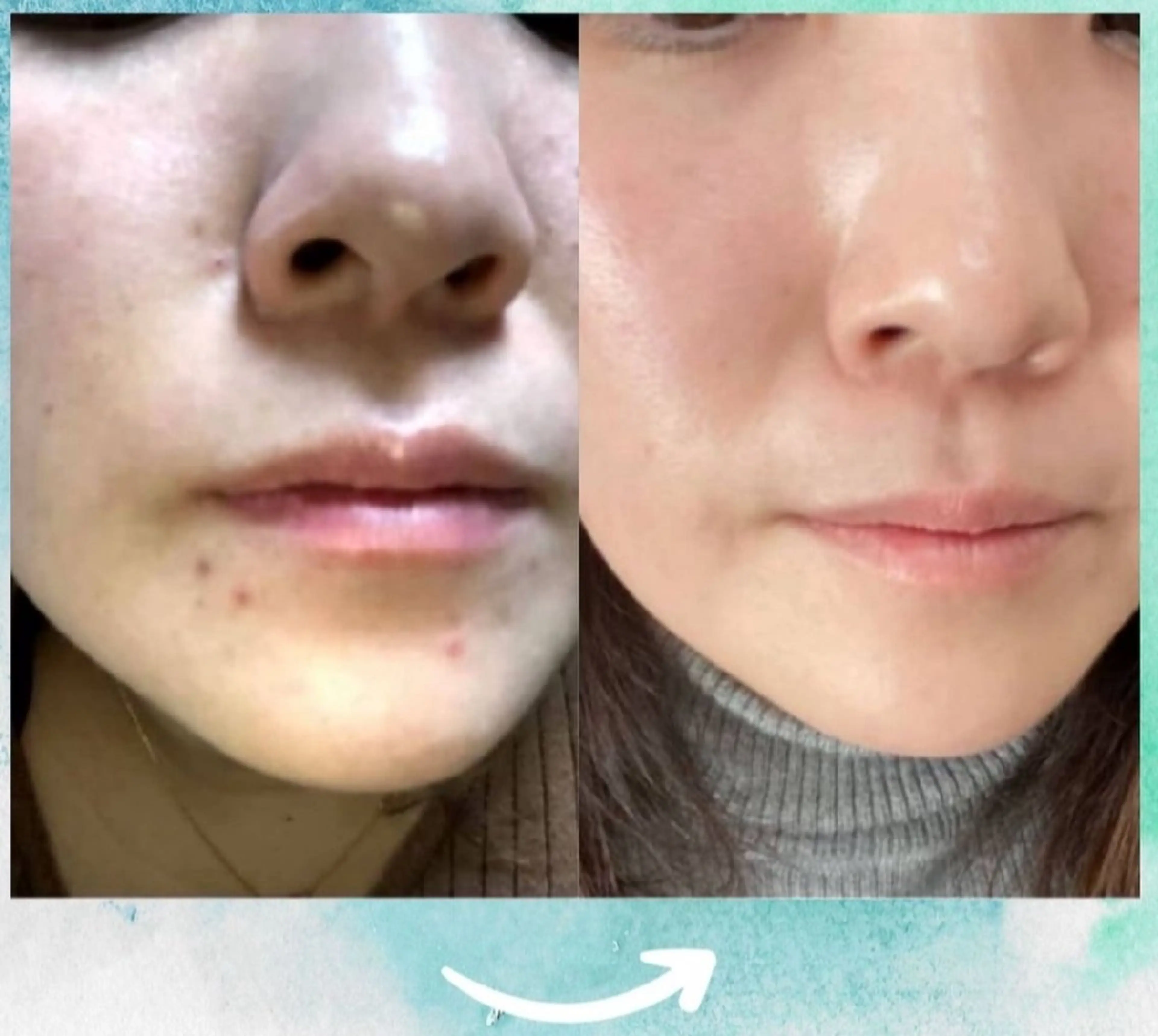 【韓国女優のような陶器肌】❤️つるりん毛穴レス体験❤️［兵庫県尼崎市/痩身エステ］の写真