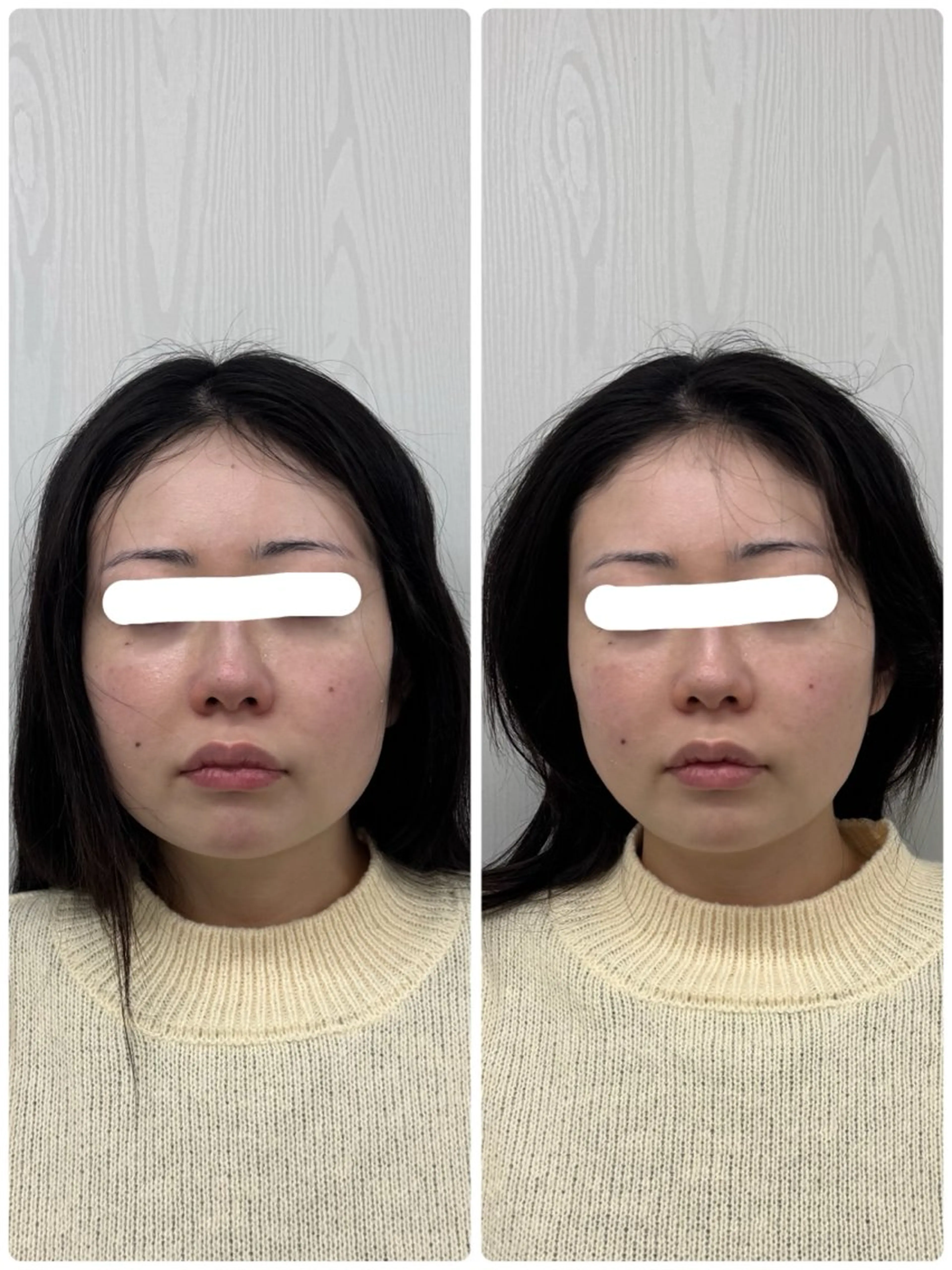 エステ 美容鍼×小顔矯正 ×美容整体　浜川泰仁のエステ・リラクイメージ