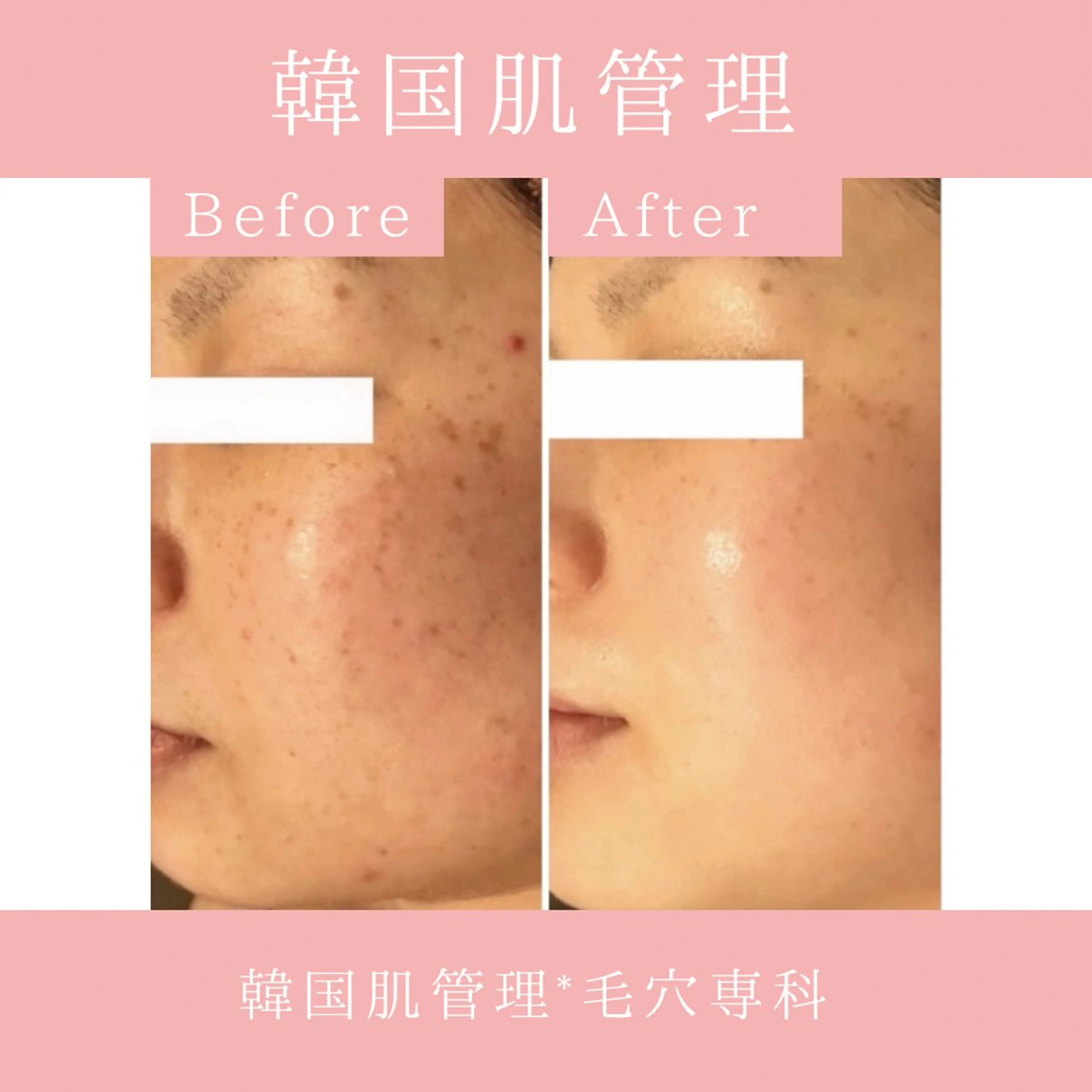 エステ リラク 韓国肌管理 【毛穴専科】のエステ・リラクイメージ