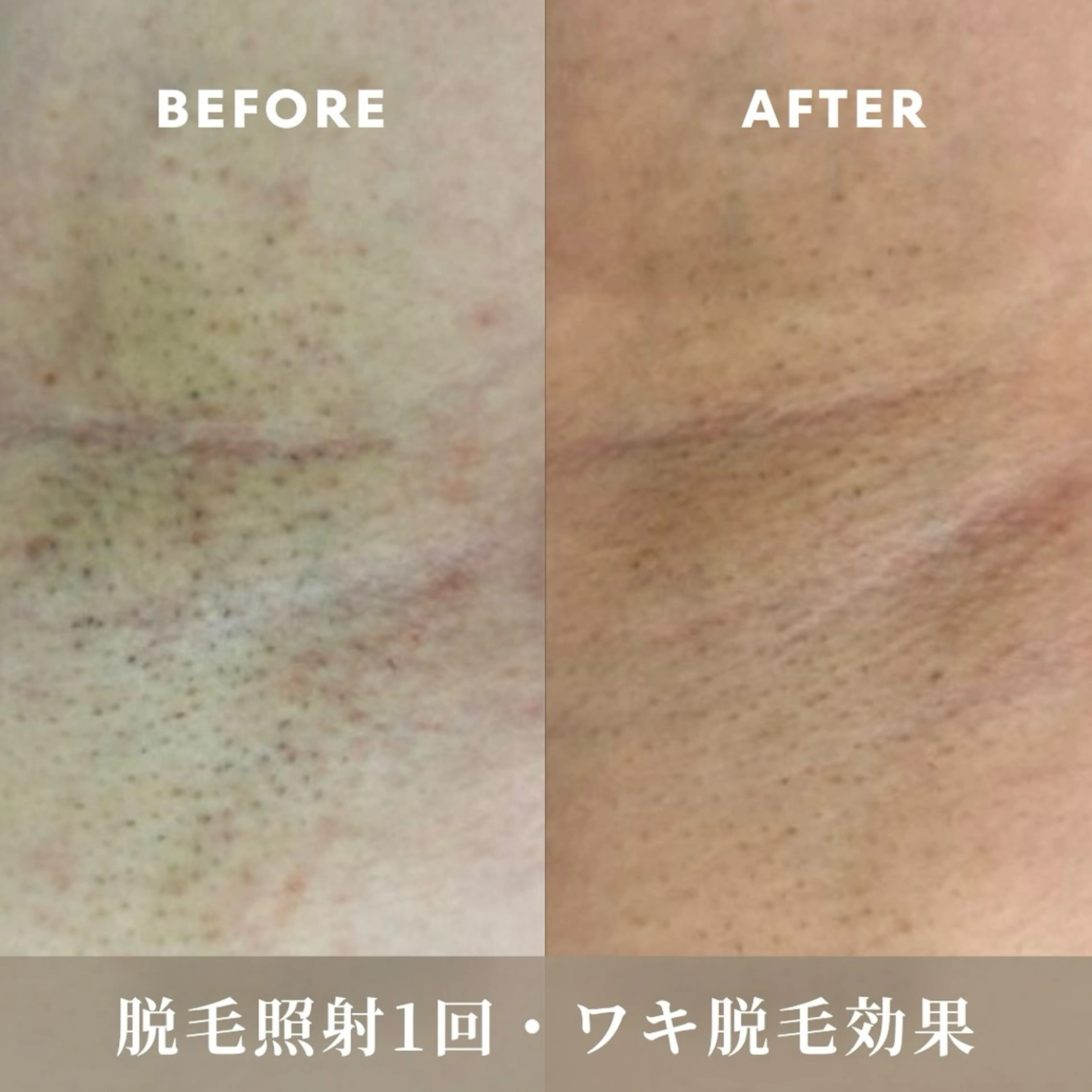 脱毛 脱毛しま専科 宗右衛門町店のエステ・リラクイメージ