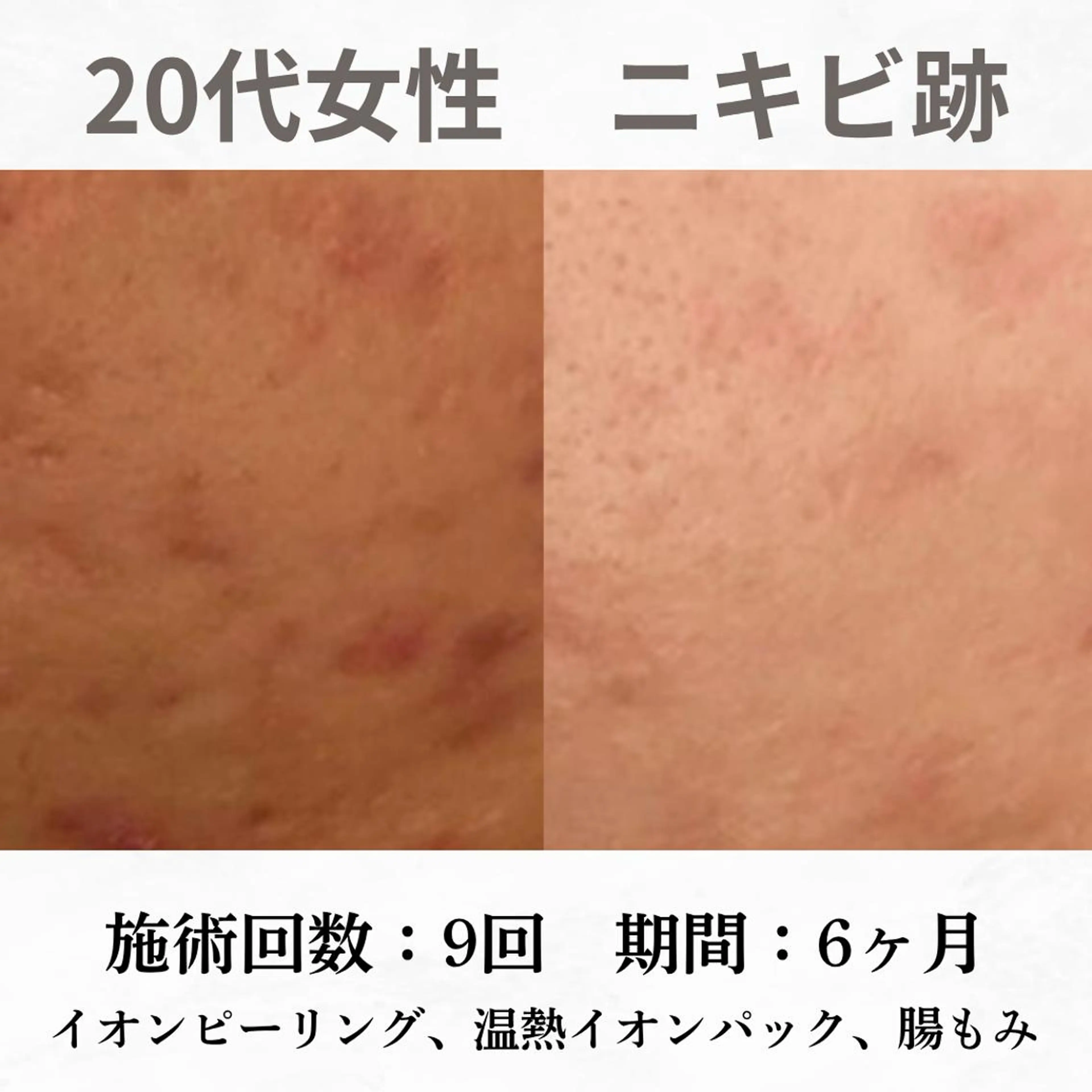 重度ニキビ専門🌷 ダウンタイムなしのエステ・リラクイメージ