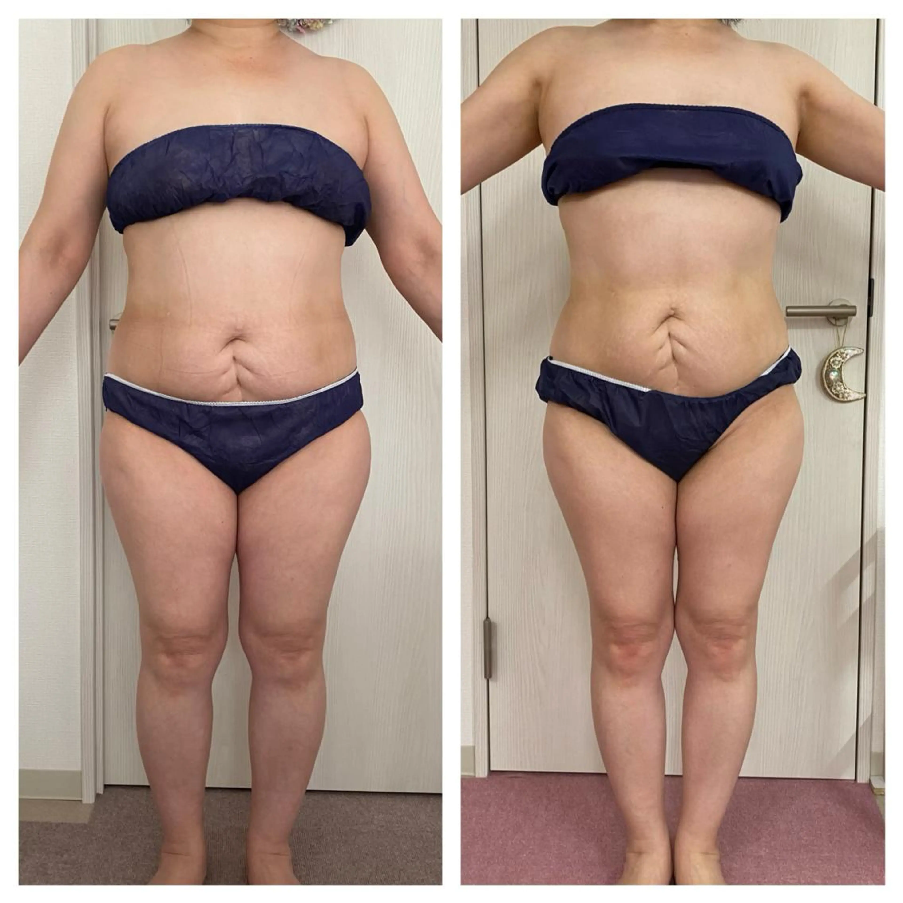 超音波、キャビテーション、EMSを使って美ボディに*痩身エステ*脚orお腹、1パーツコースの写真