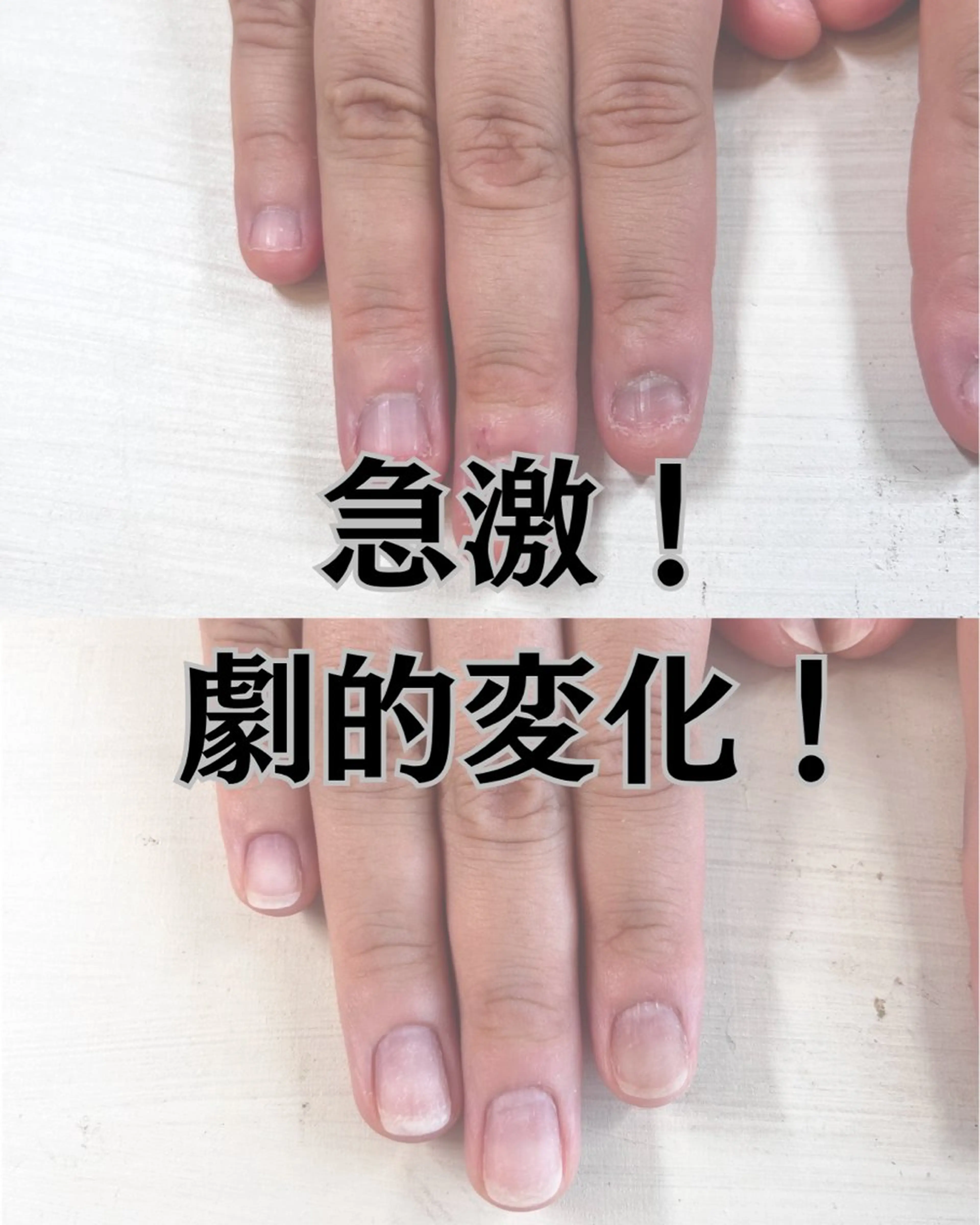 ネイル 深爪矯正・自爪育成 ヴェールリムのネイルデザイン