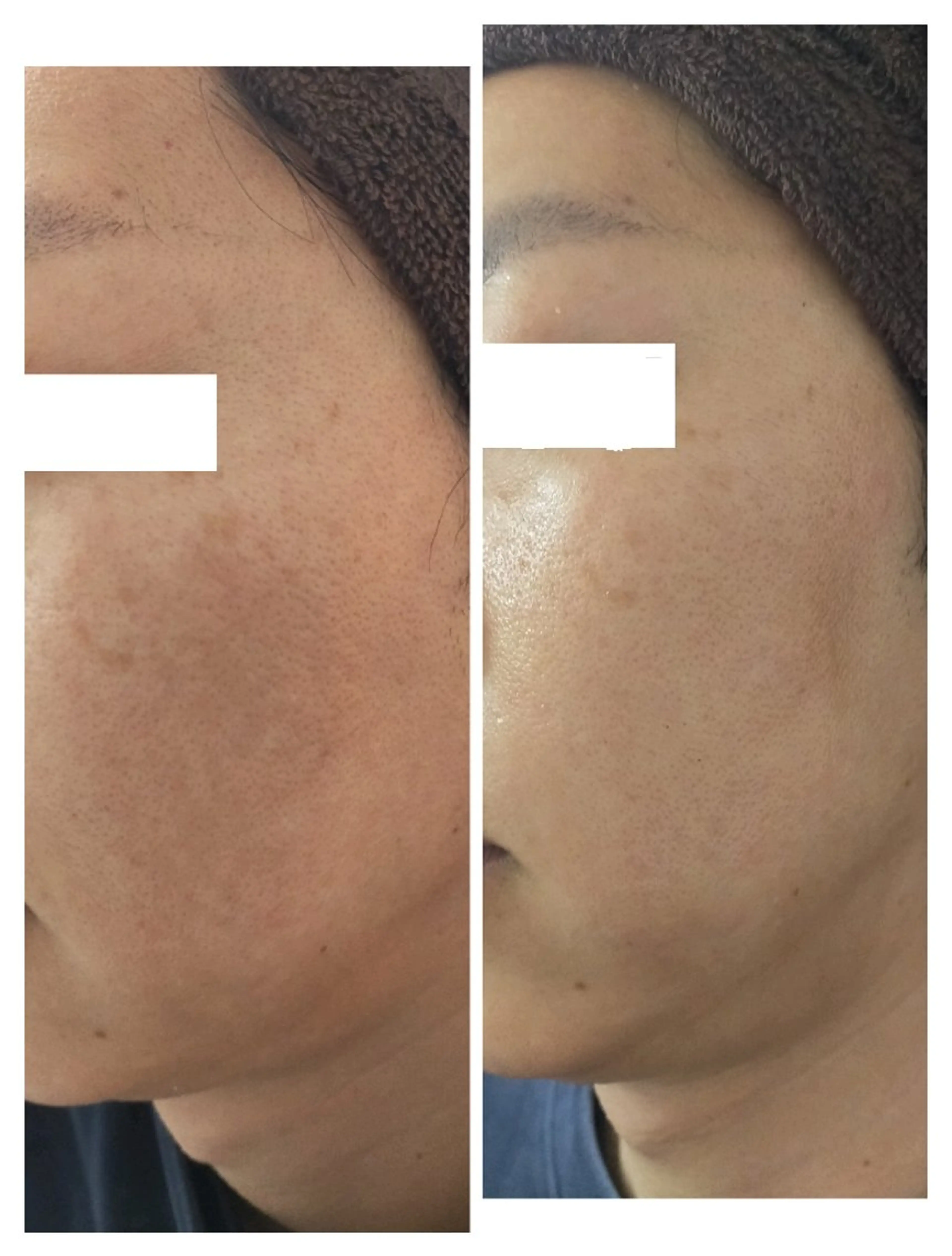 【毛穴・くすみスッキリ！】 炎症抑制×しっかりお掃除！の写真