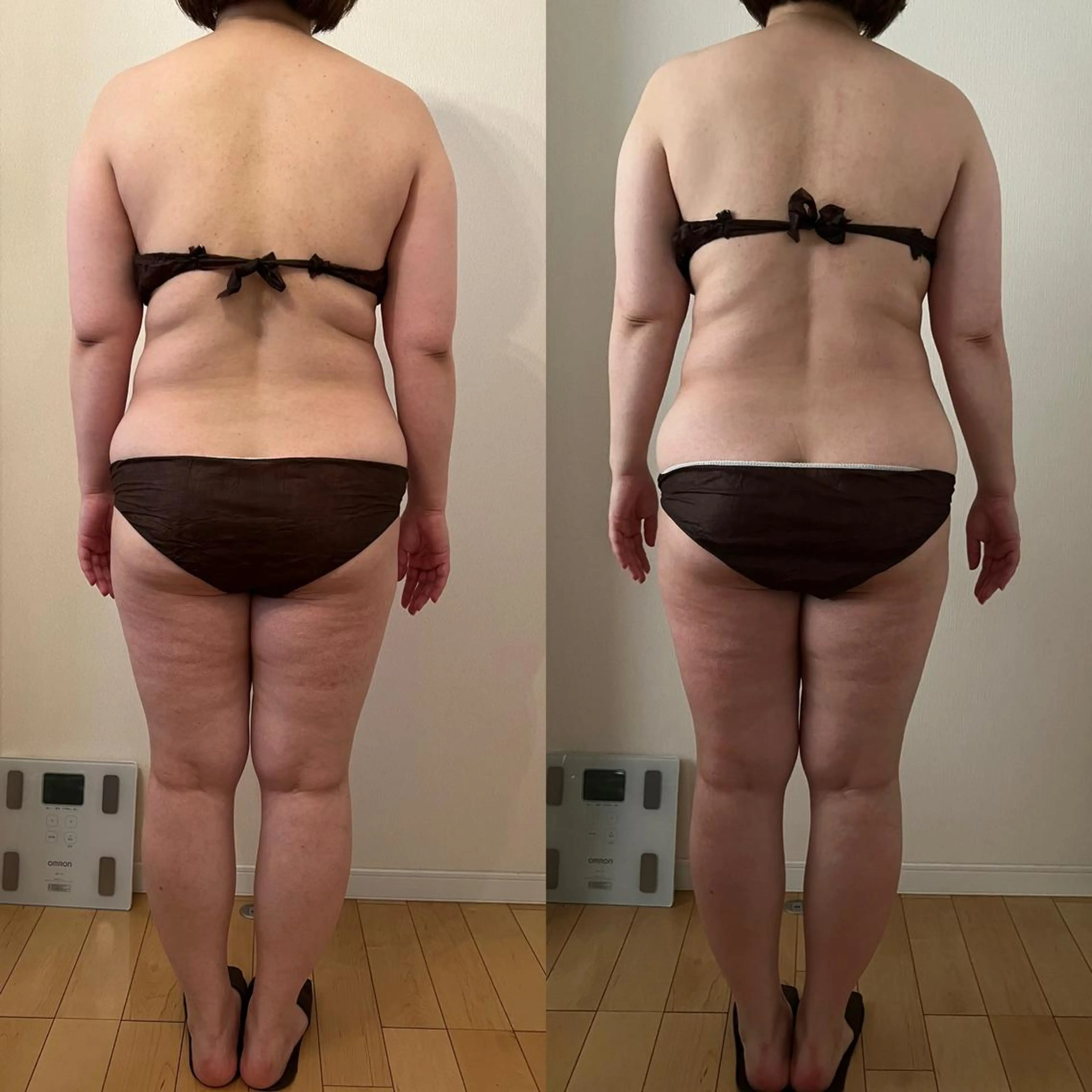 筋膜リリース＆セルライト対策の写真