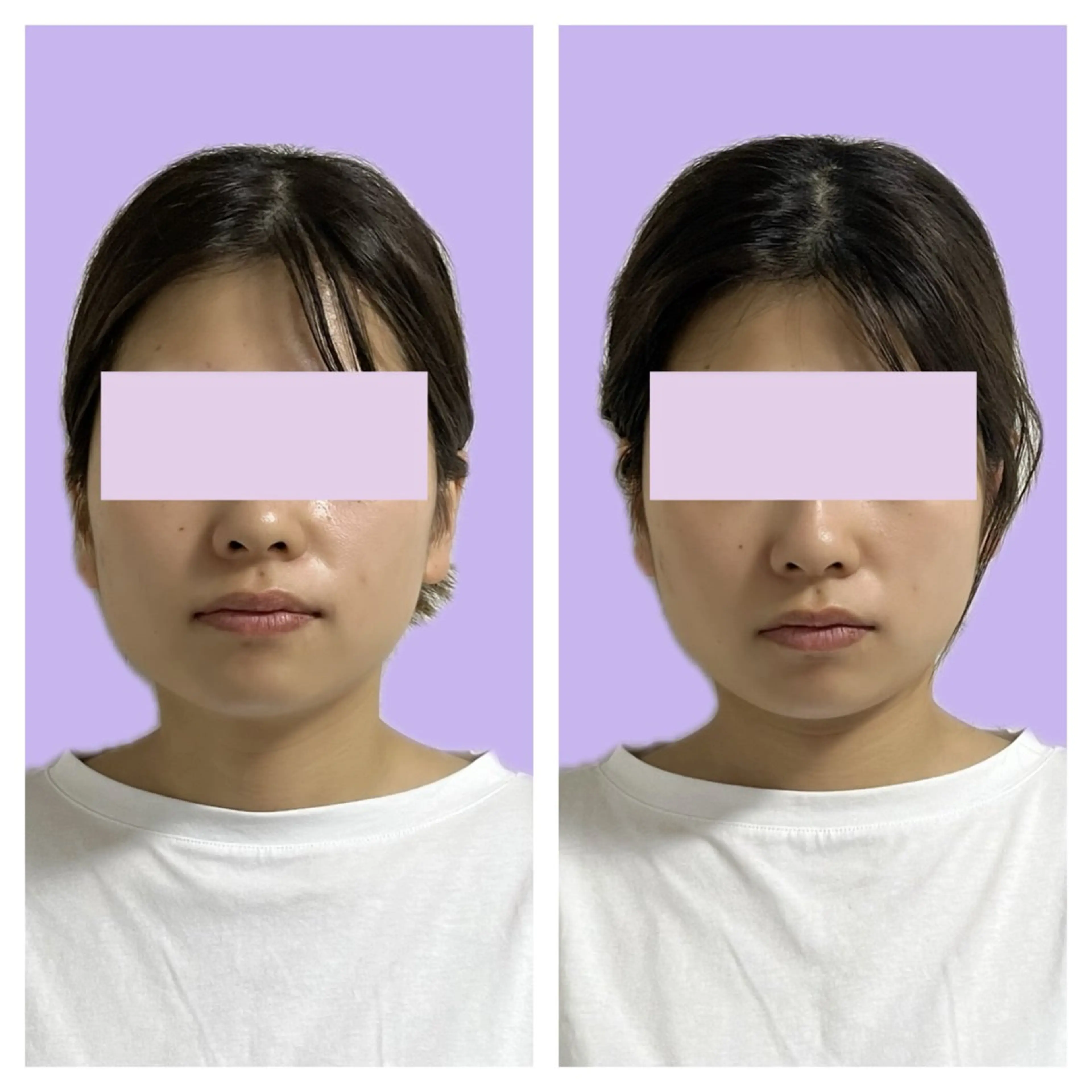 ‼️特別価格‼️小顔美容整骨矯正　　4,500円の写真