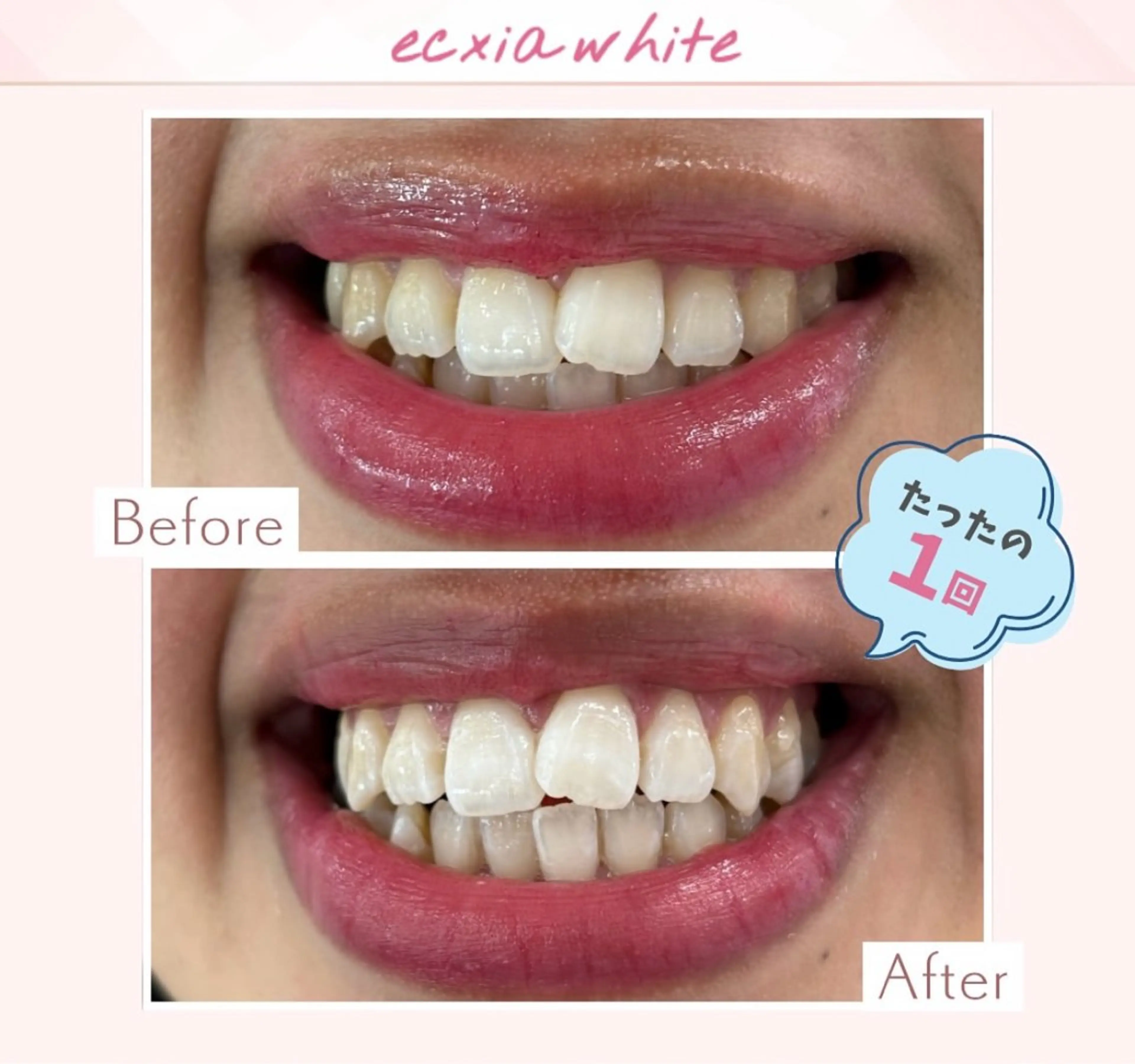 yumi❤︎ ホワイトニングのその他イメージ