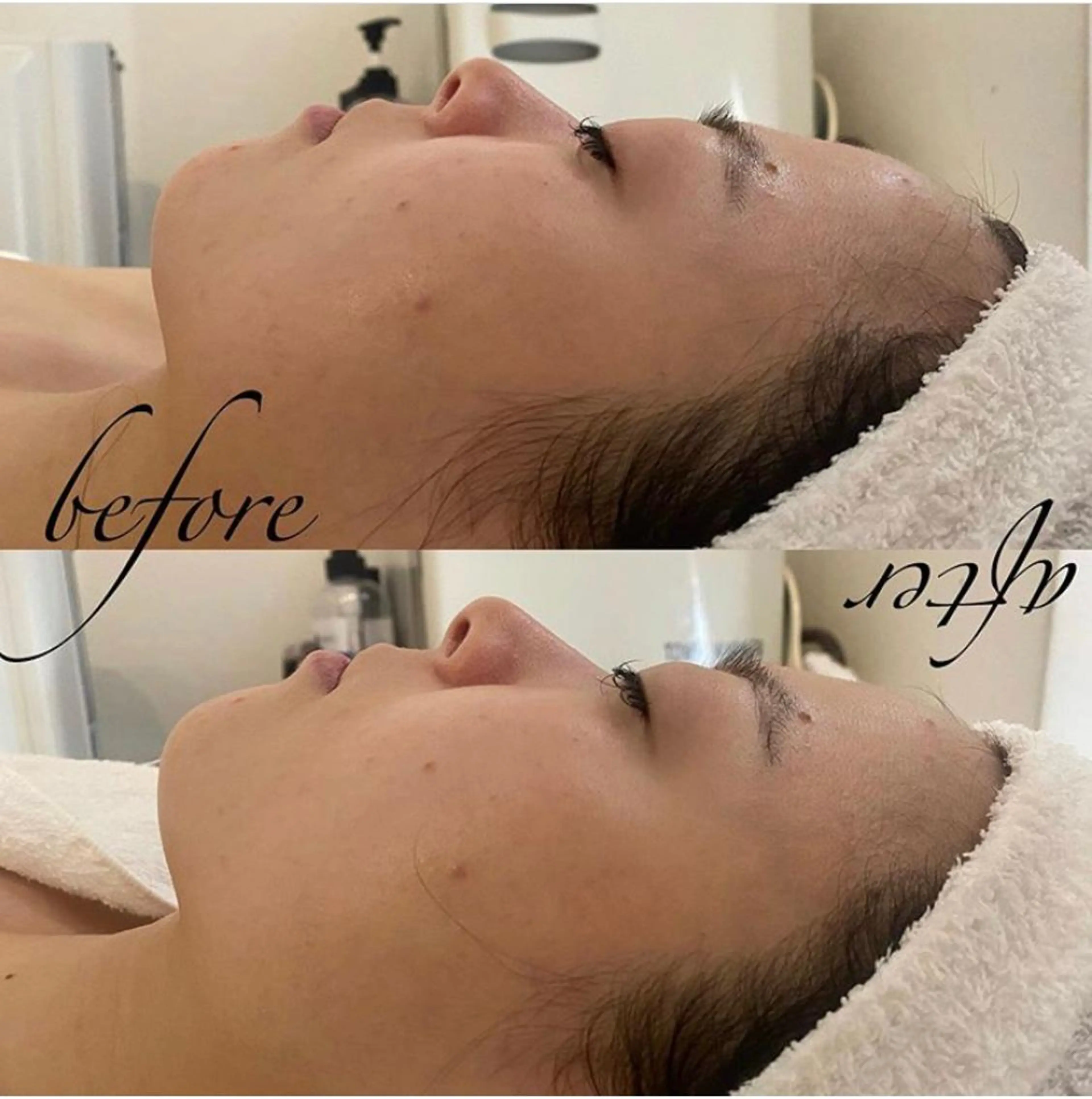 エステ リラク 韓国/ピーリング 毛穴洗浄/POLAのエステ・リラクイメージ