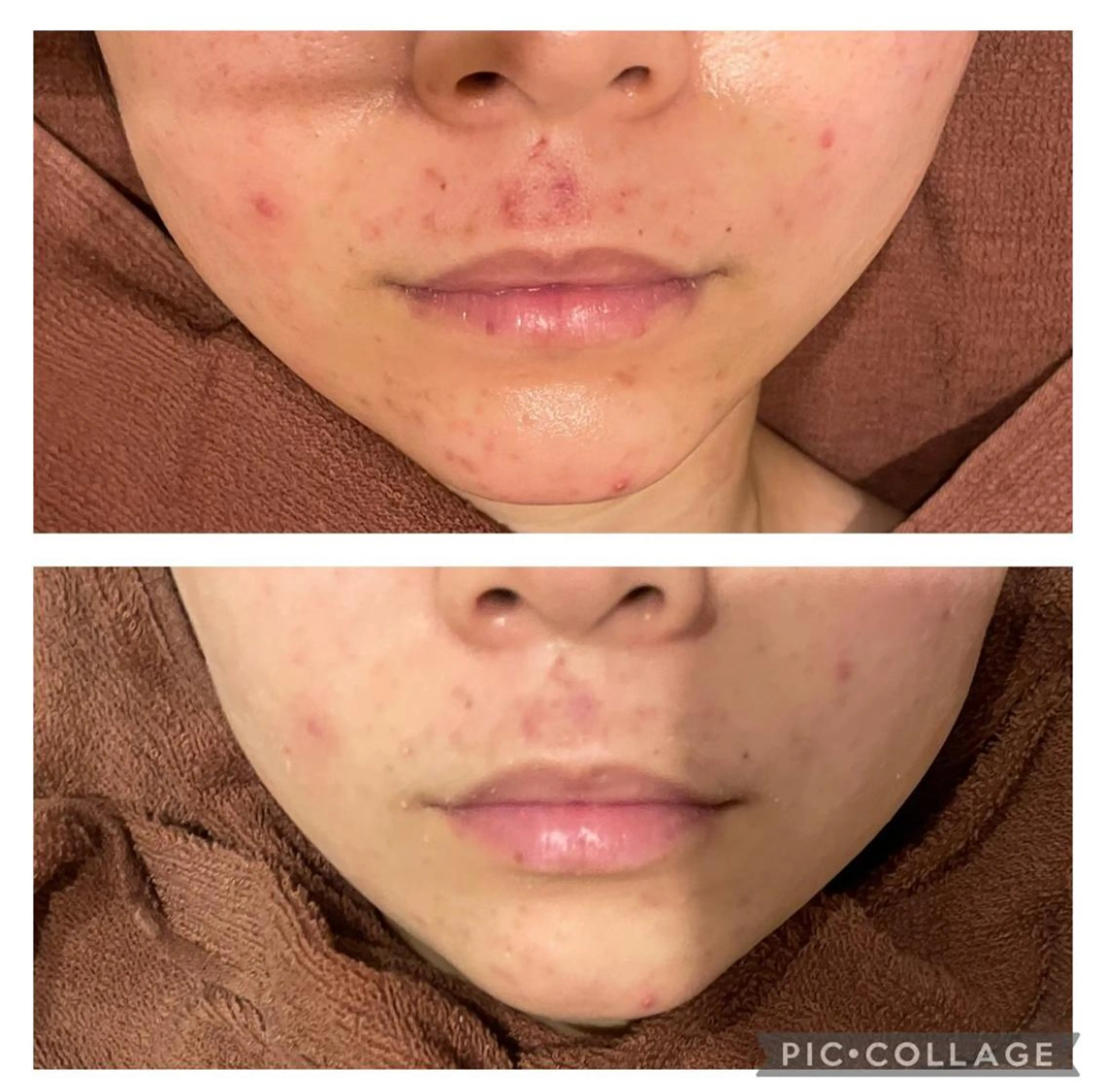 3か月で肌革命👼 ニキビ専門店💫のエステ・リラクイメージ