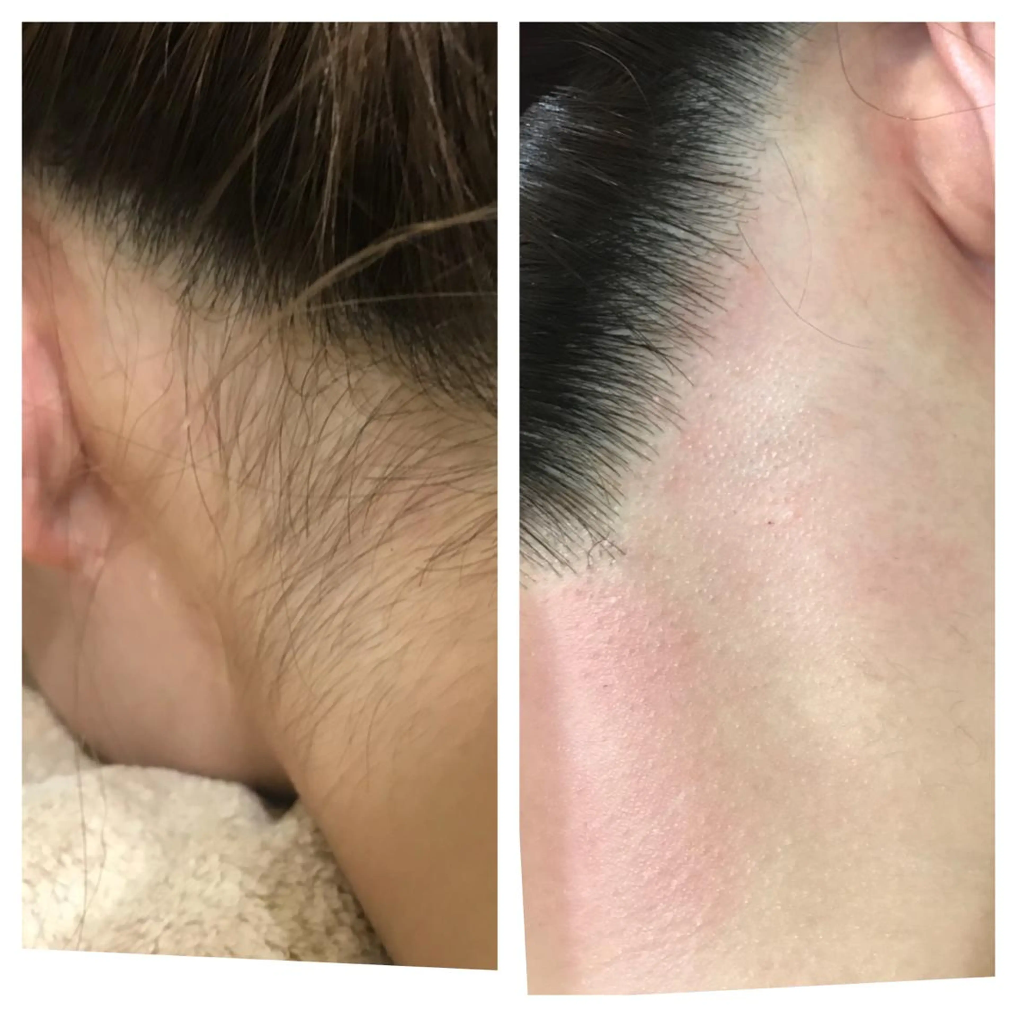 脱毛 フェイシャル/脱毛 ジョアアンジェ　田中のエステ・リラクイメージ