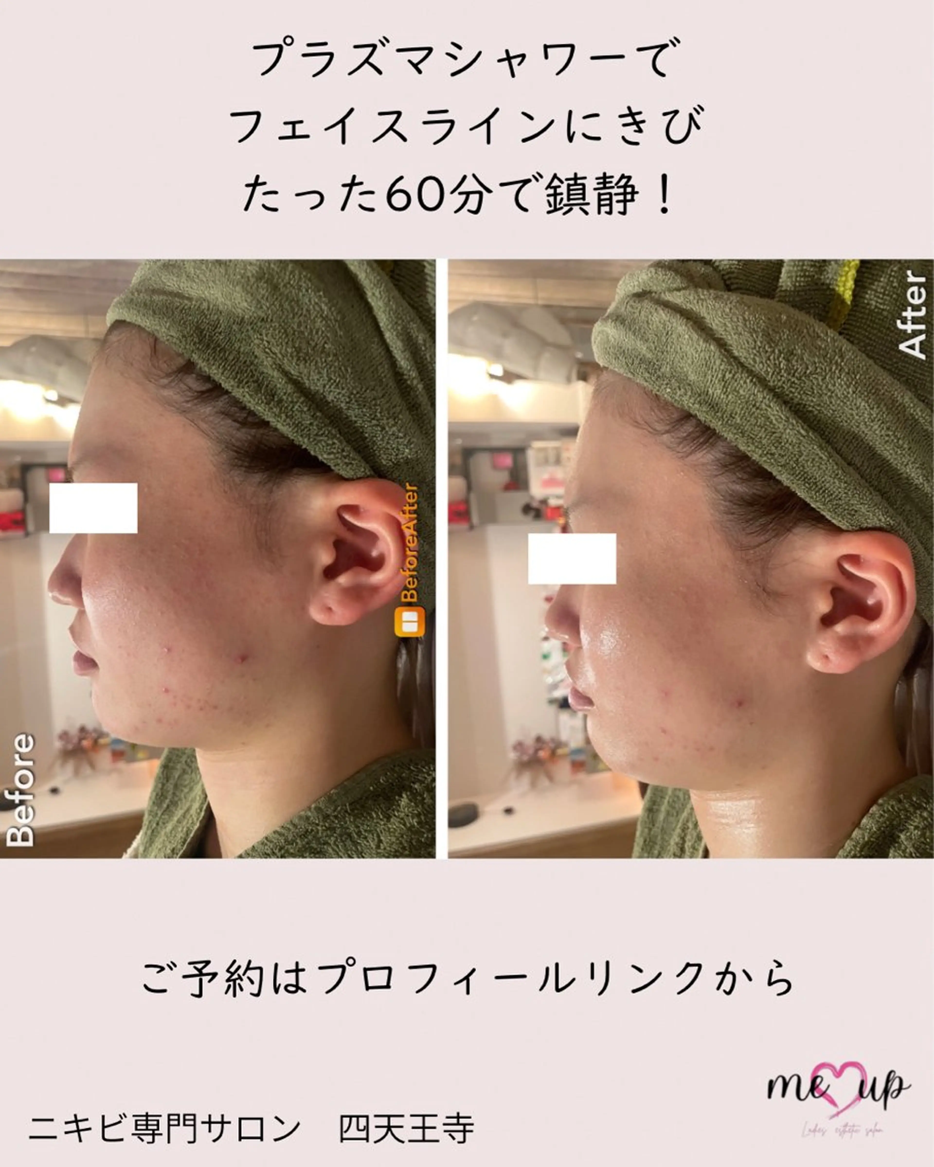 エステ Meupニキビ専門店 背中/ハーブ/肌管理のその他イメージ