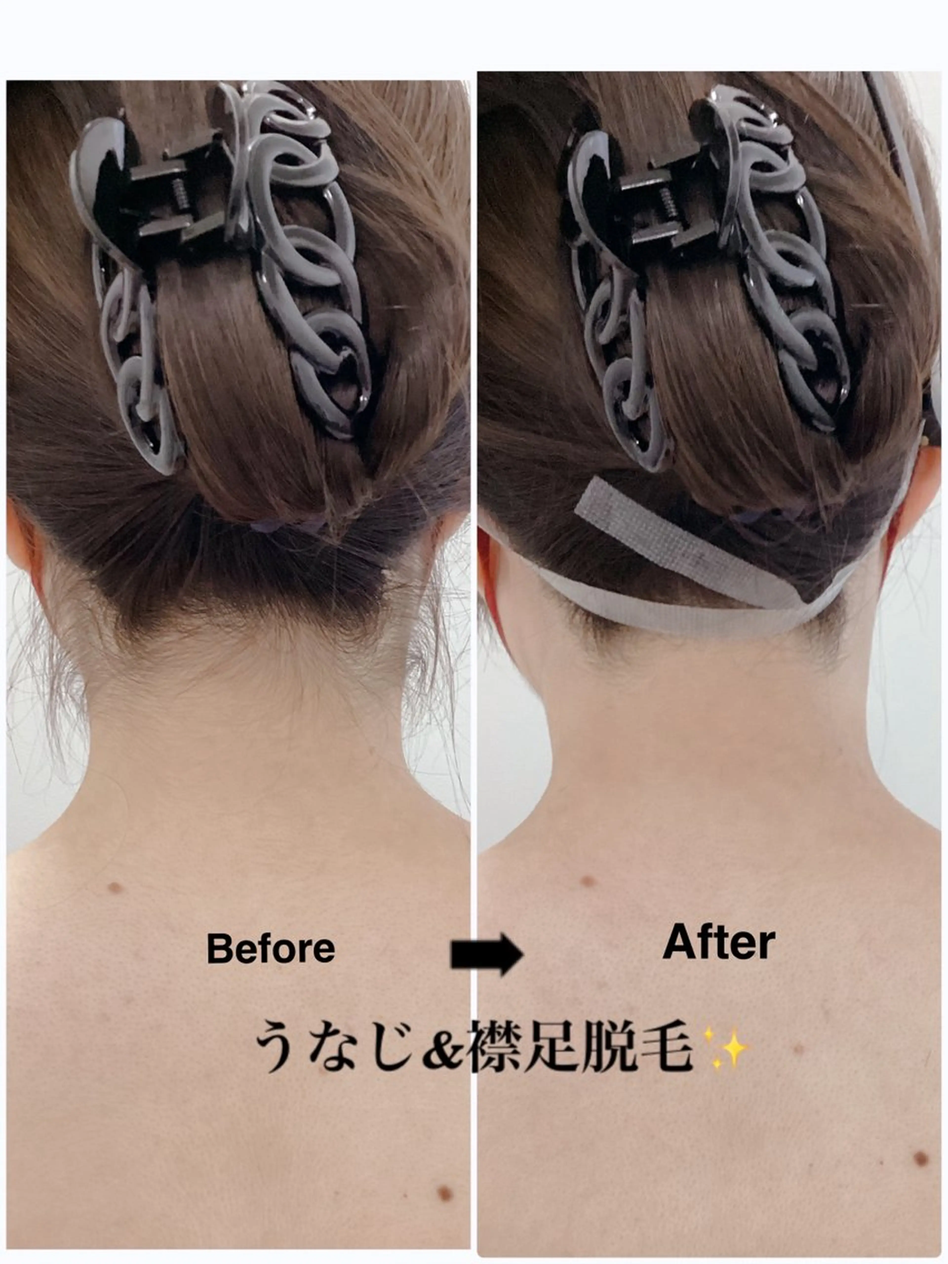 ☃️うなじ&襟足脱毛☃️¥2,800→¥1,500の写真