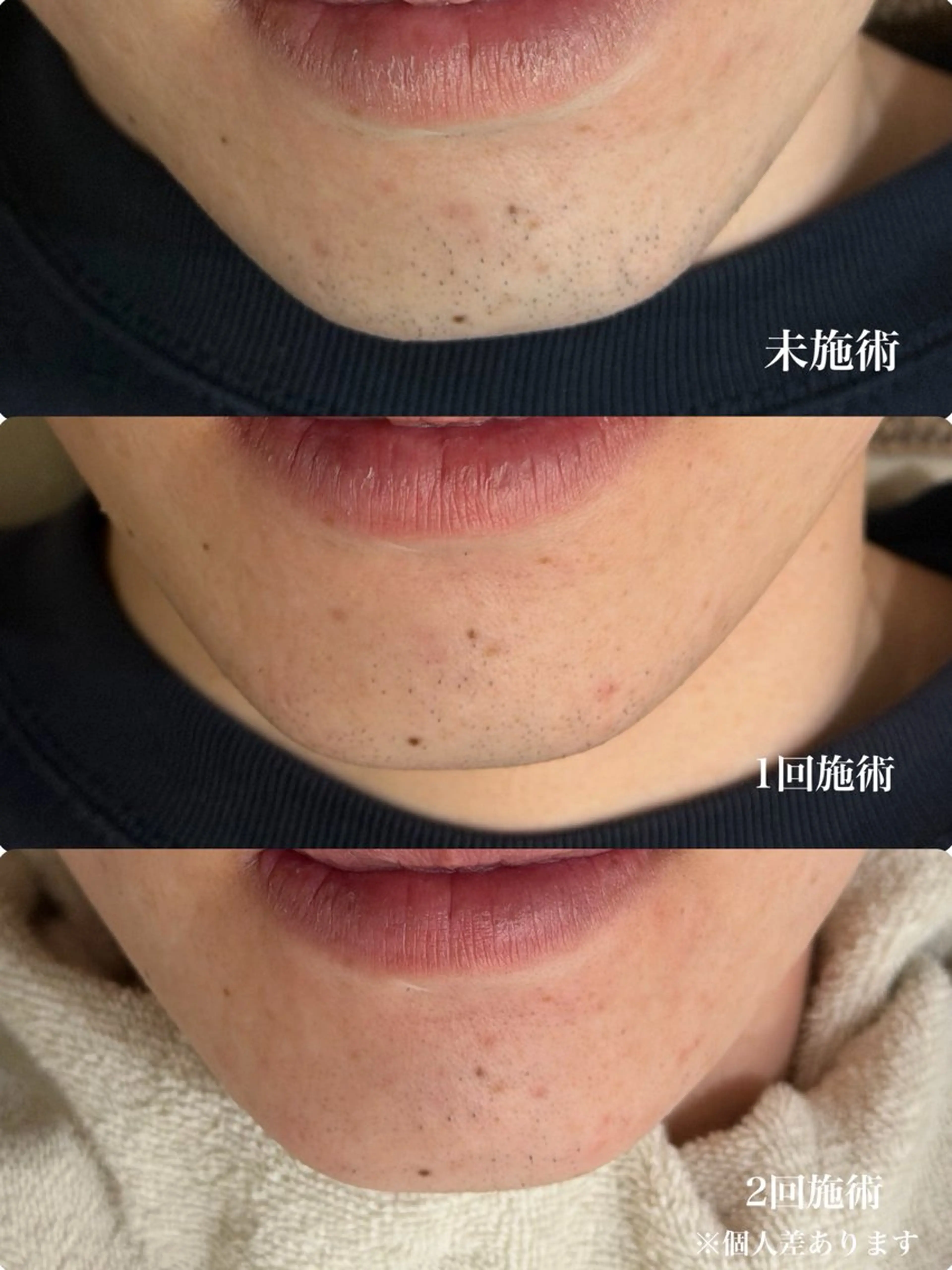 メンズ 脱毛 muumo まりののエステ・リラクイメージ