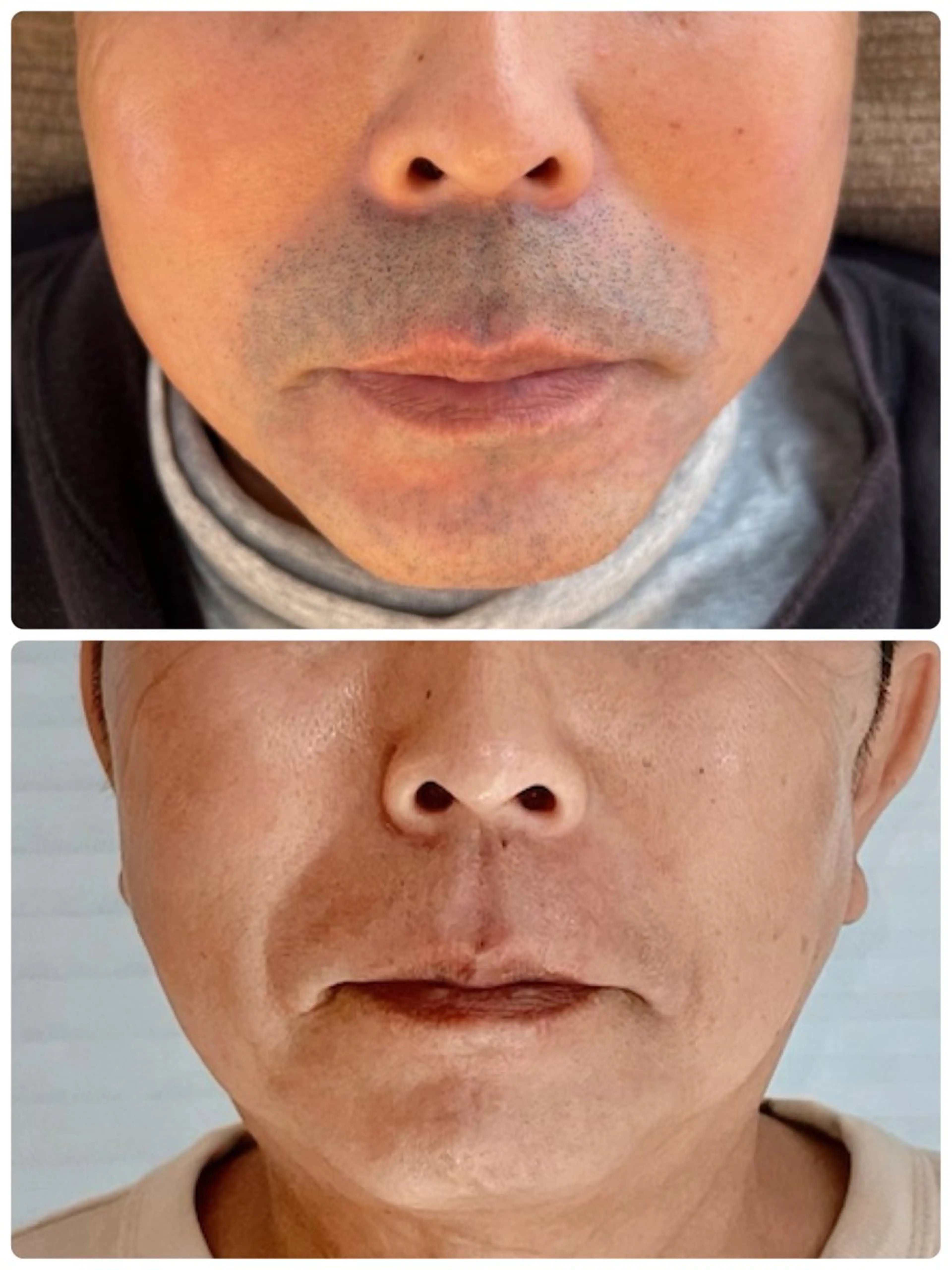 メンズ 全身脱毛/韓国ツヤ肌 ハーブピーリングのエステ・リラクイメージ