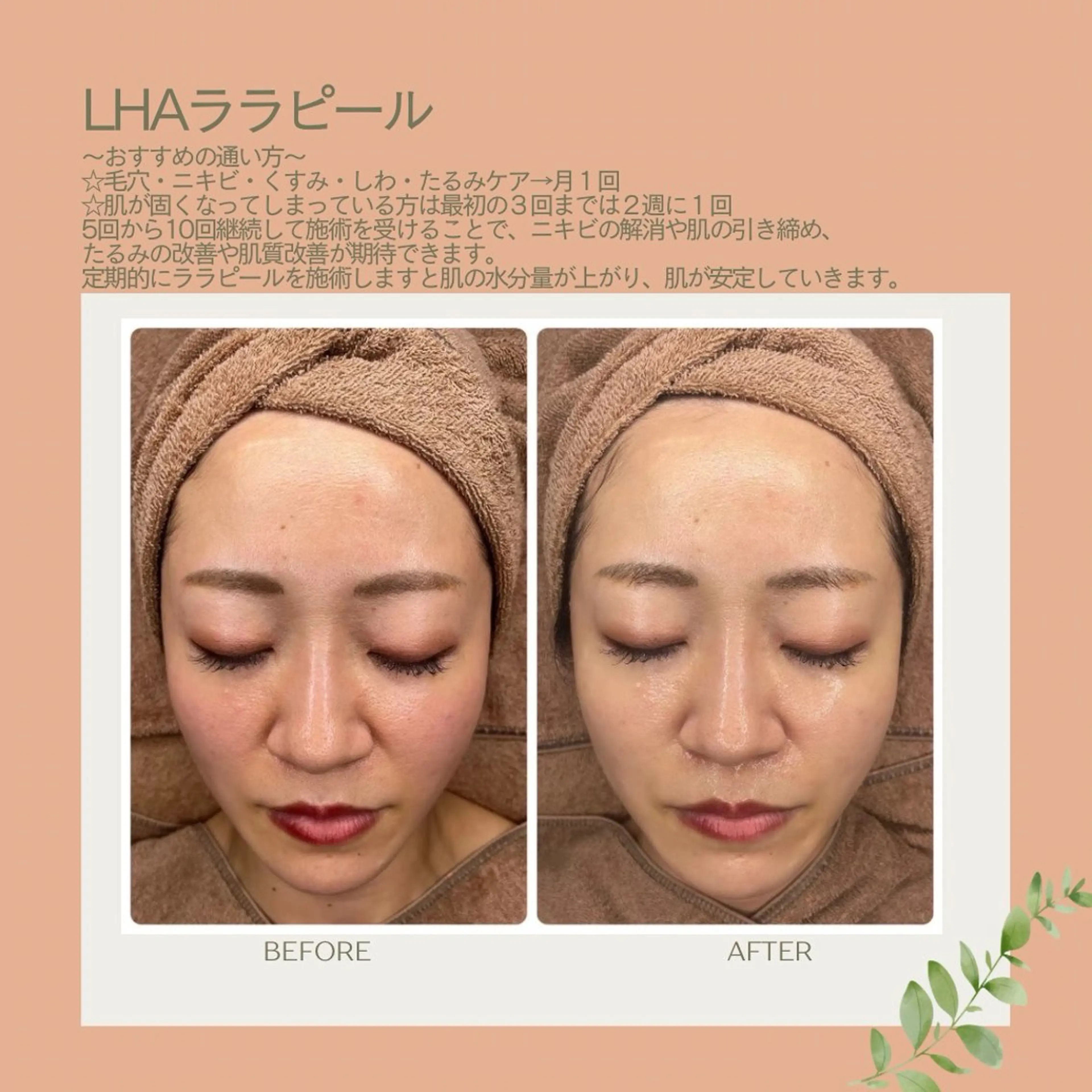 内側から肌を育てるピーリング🌷LHAララピール💚毛穴/ニキビ/くすみ/たるみ/エイジングケア/肌質改善の写真