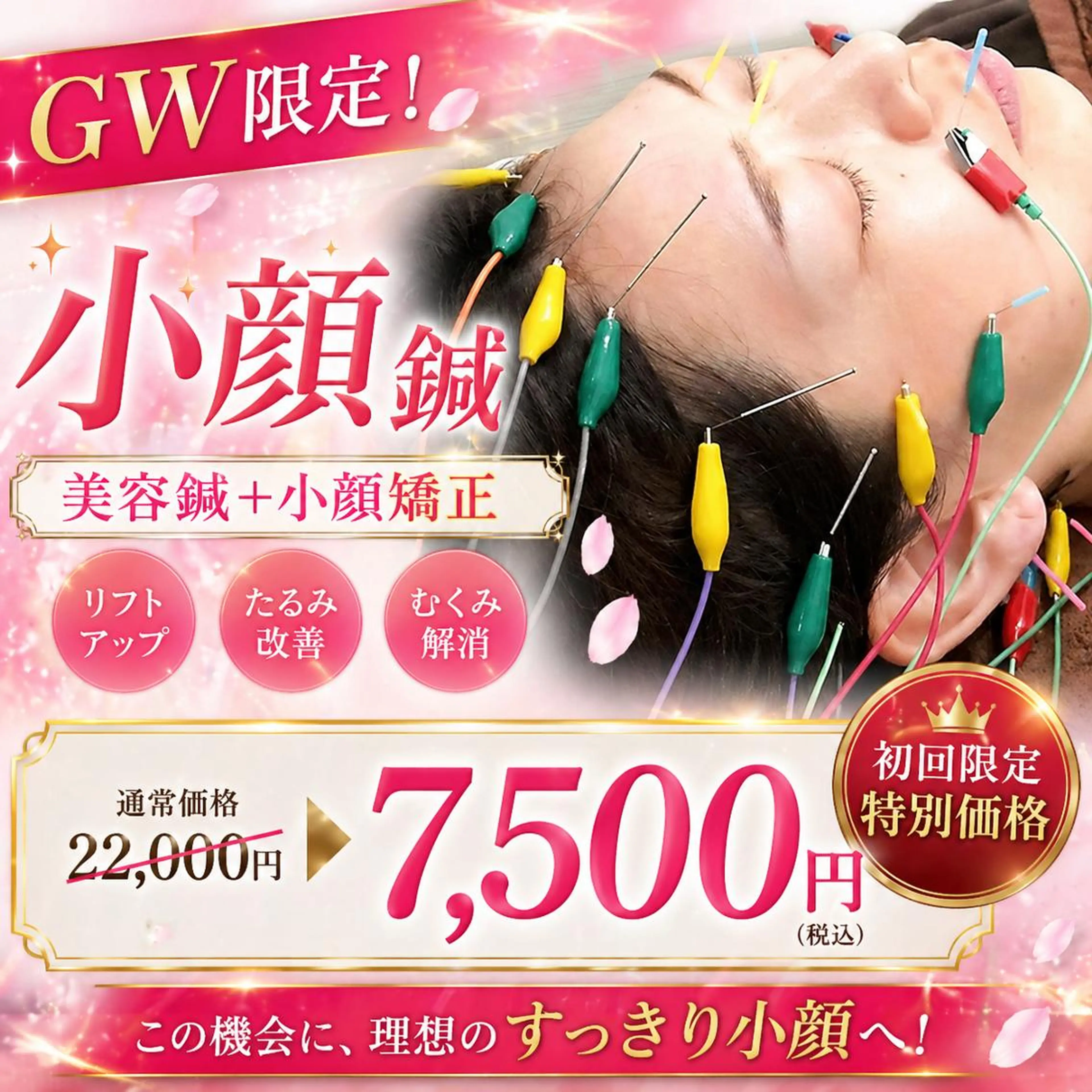 5/１〜5/6のGW限定！【人気No１】【小顔針】120分⭐️美容鍼＋小顔矯正＋フェイシャルマッサージの写真