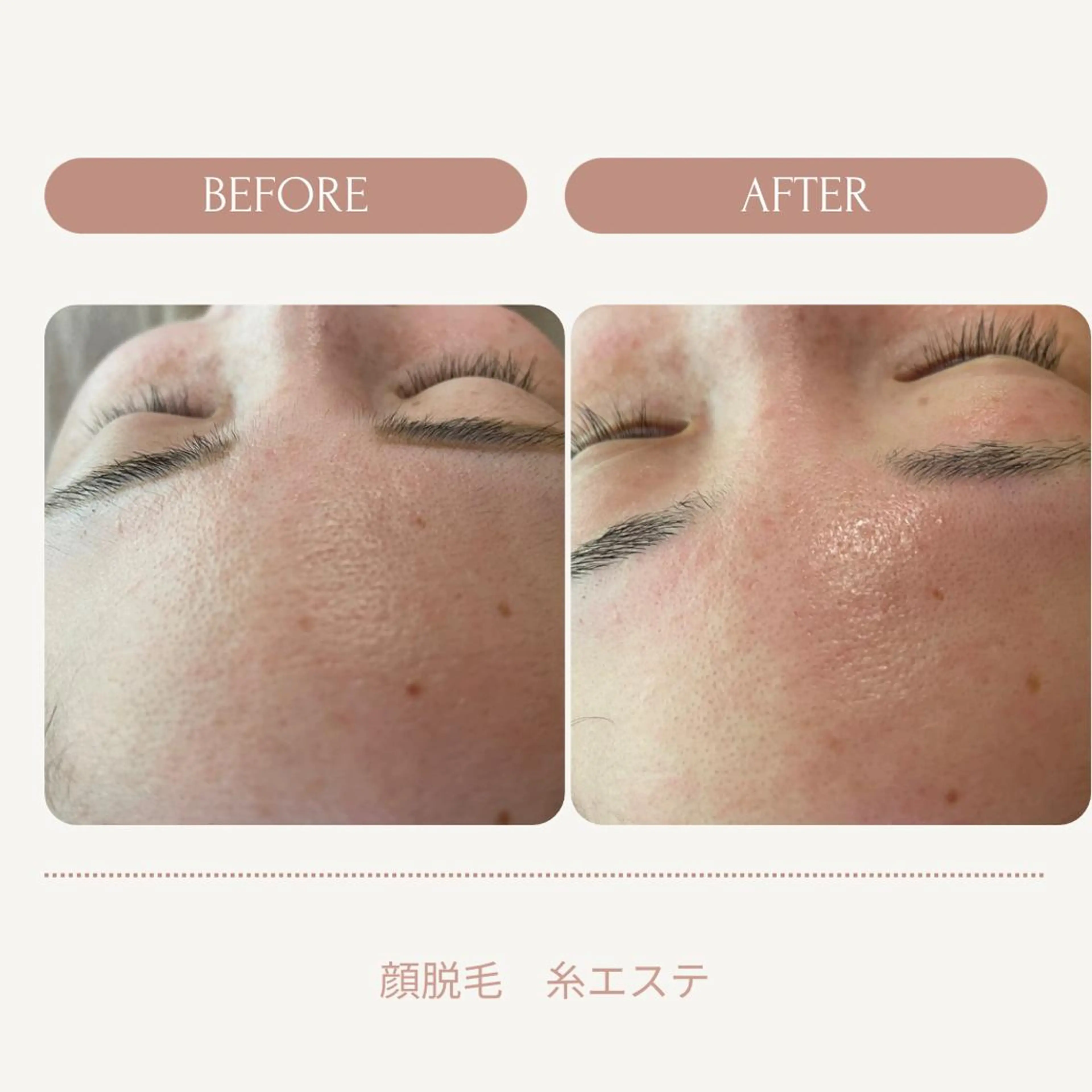 エステ 肌荒れに悩む方のため オイルフリーサロンのマツエク・マツパデザイン