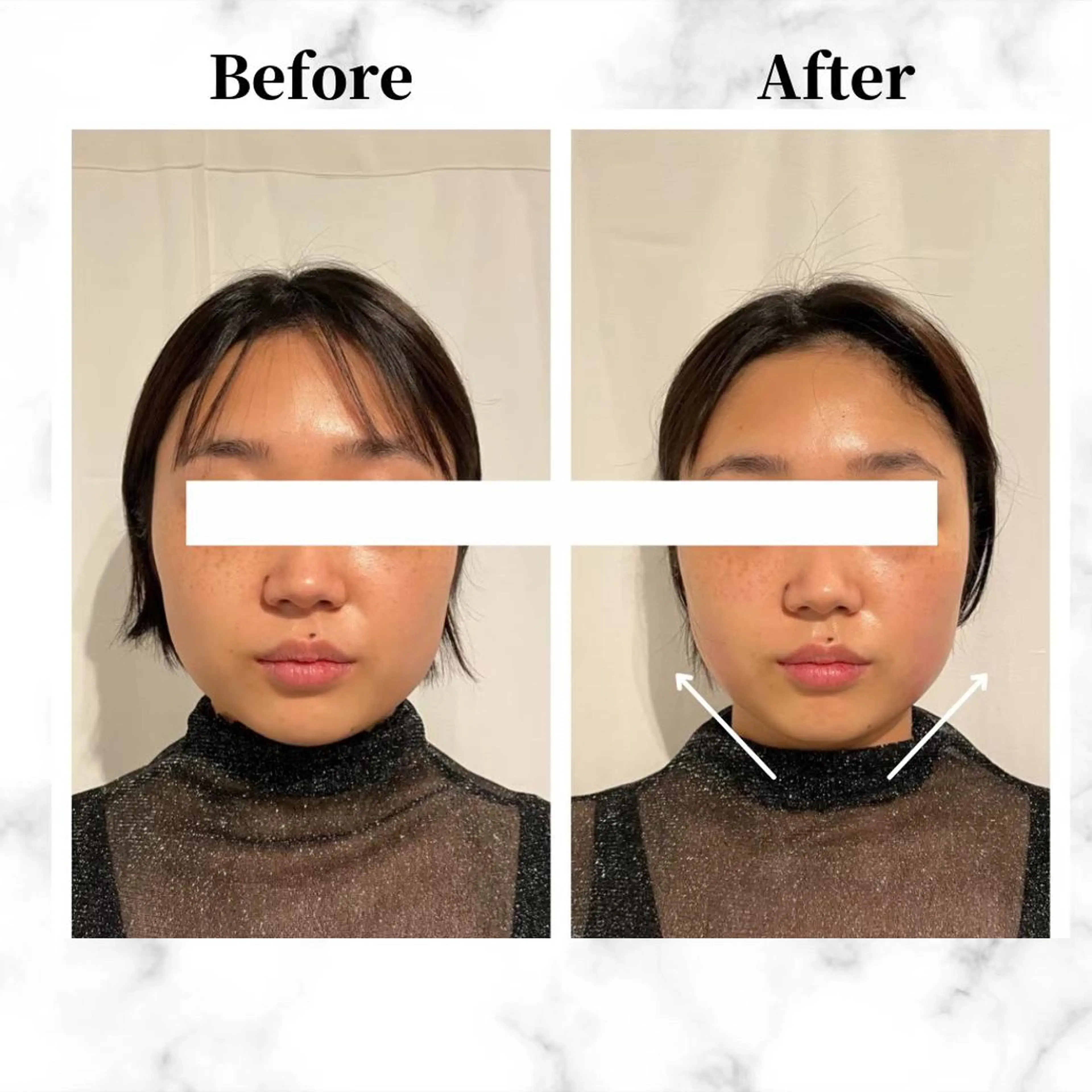 12Dハイフ💗 最強小顔のエステ・リラクイメージ