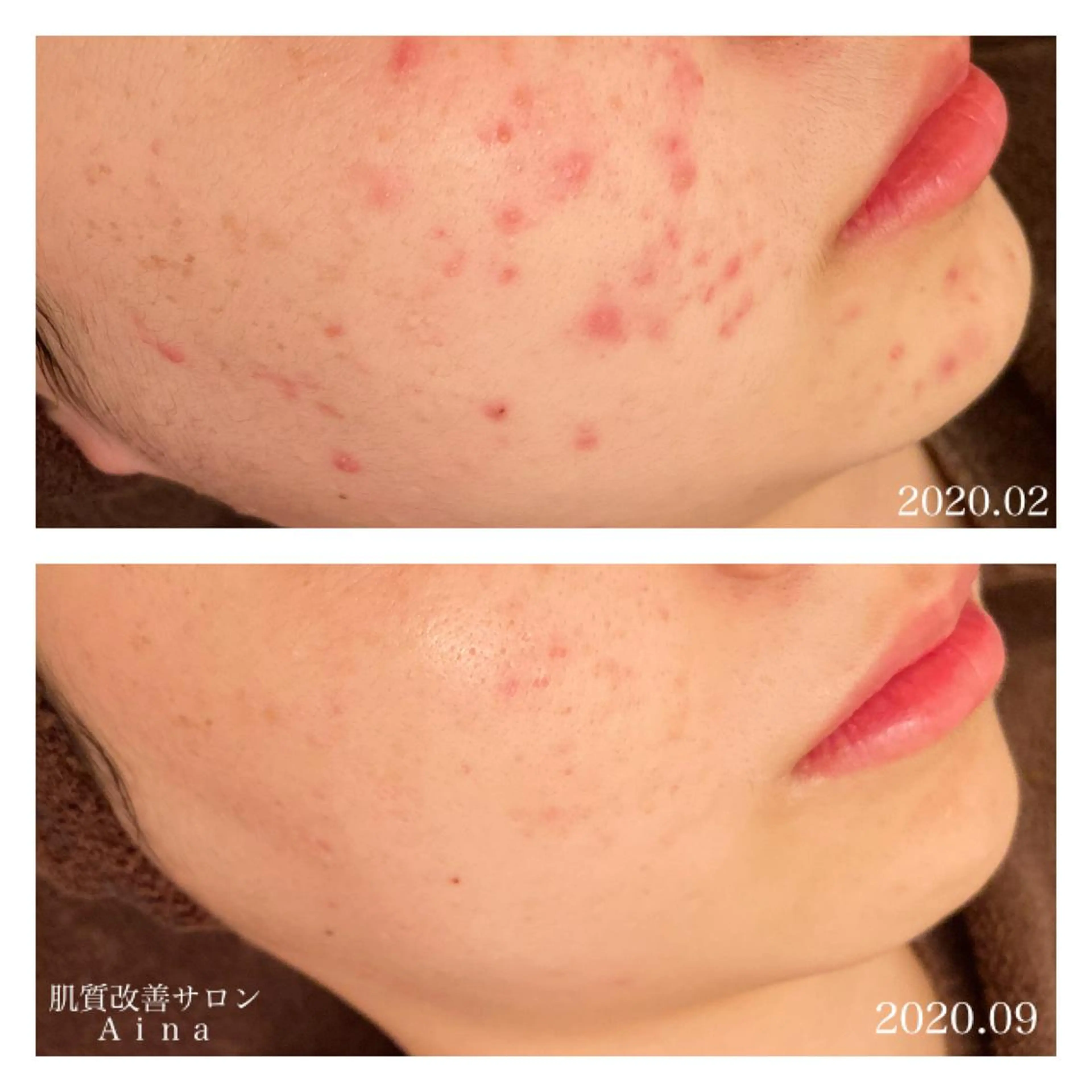 ミディアム カラー パーマ ヘアアレンジ メンズ キッズ ネイル マツエク・マツパ 赤色 エステ リラク ニキビ跡専門サロン Ａｉｎａのエステ・リラクイメージ