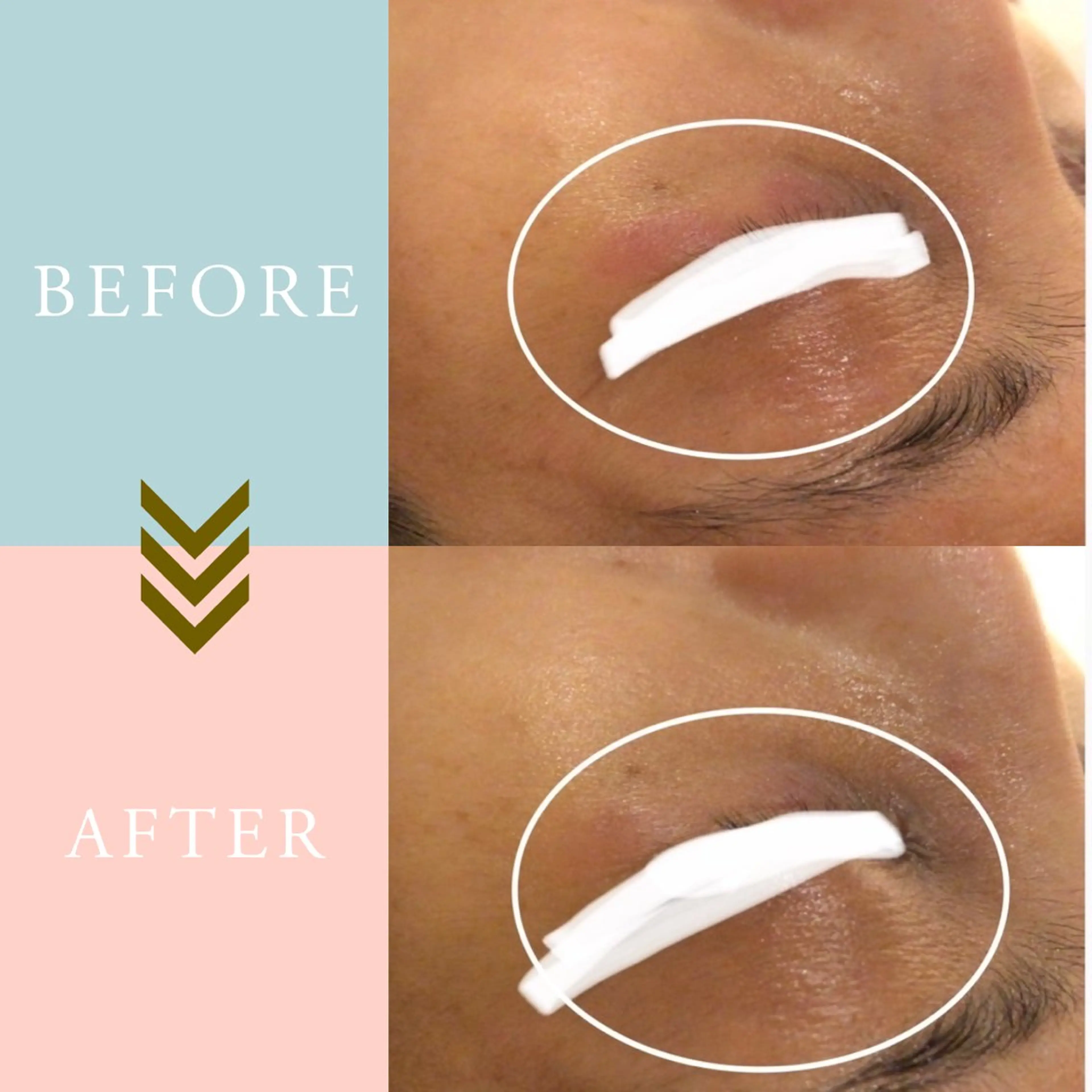 繰り返すニキビ・毛穴 ✨つくば肌質改善専門のエステ・リラクイメージ