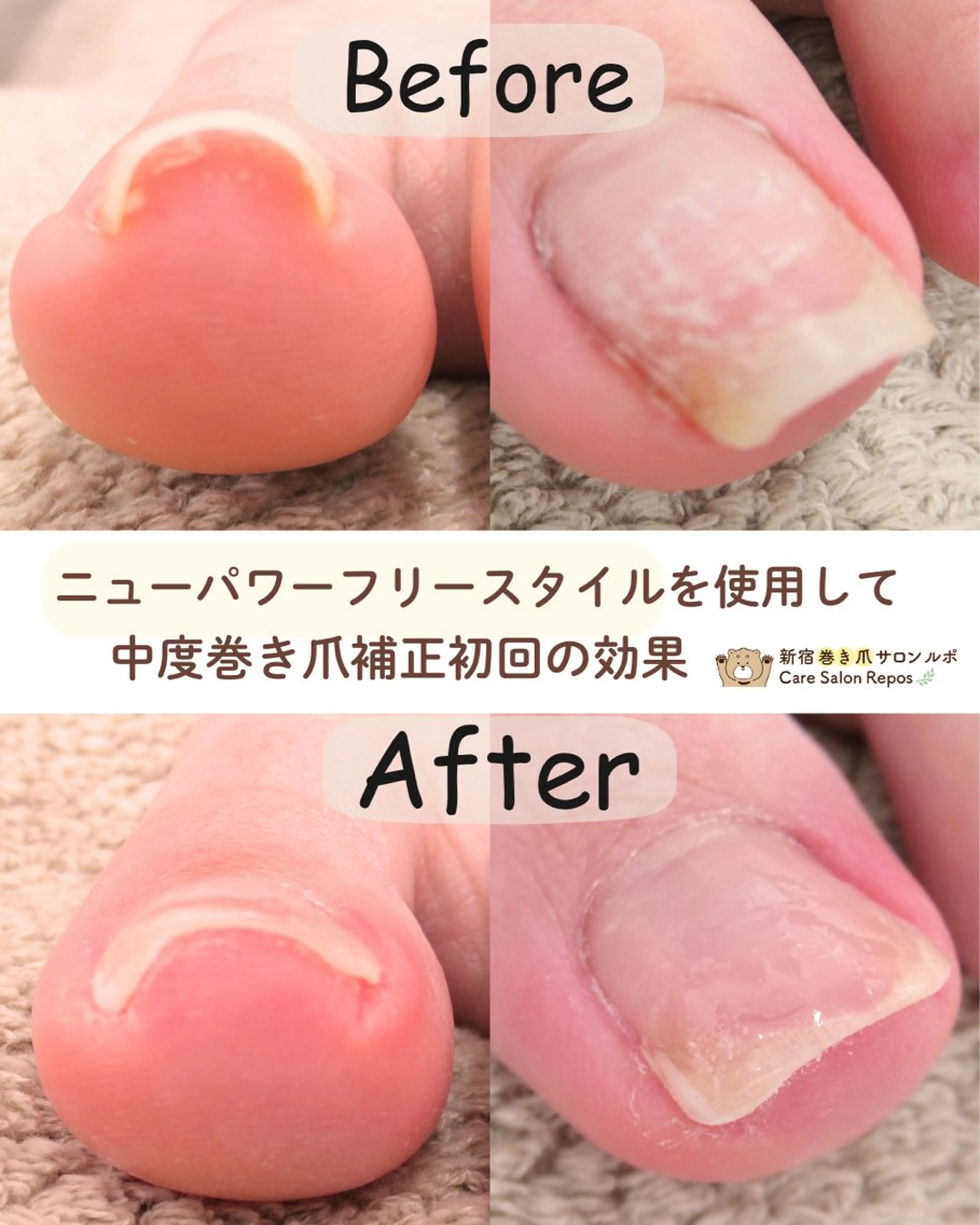 ネイル フットネイル 新宿巻き爪ケア ルポのネイルデザイン