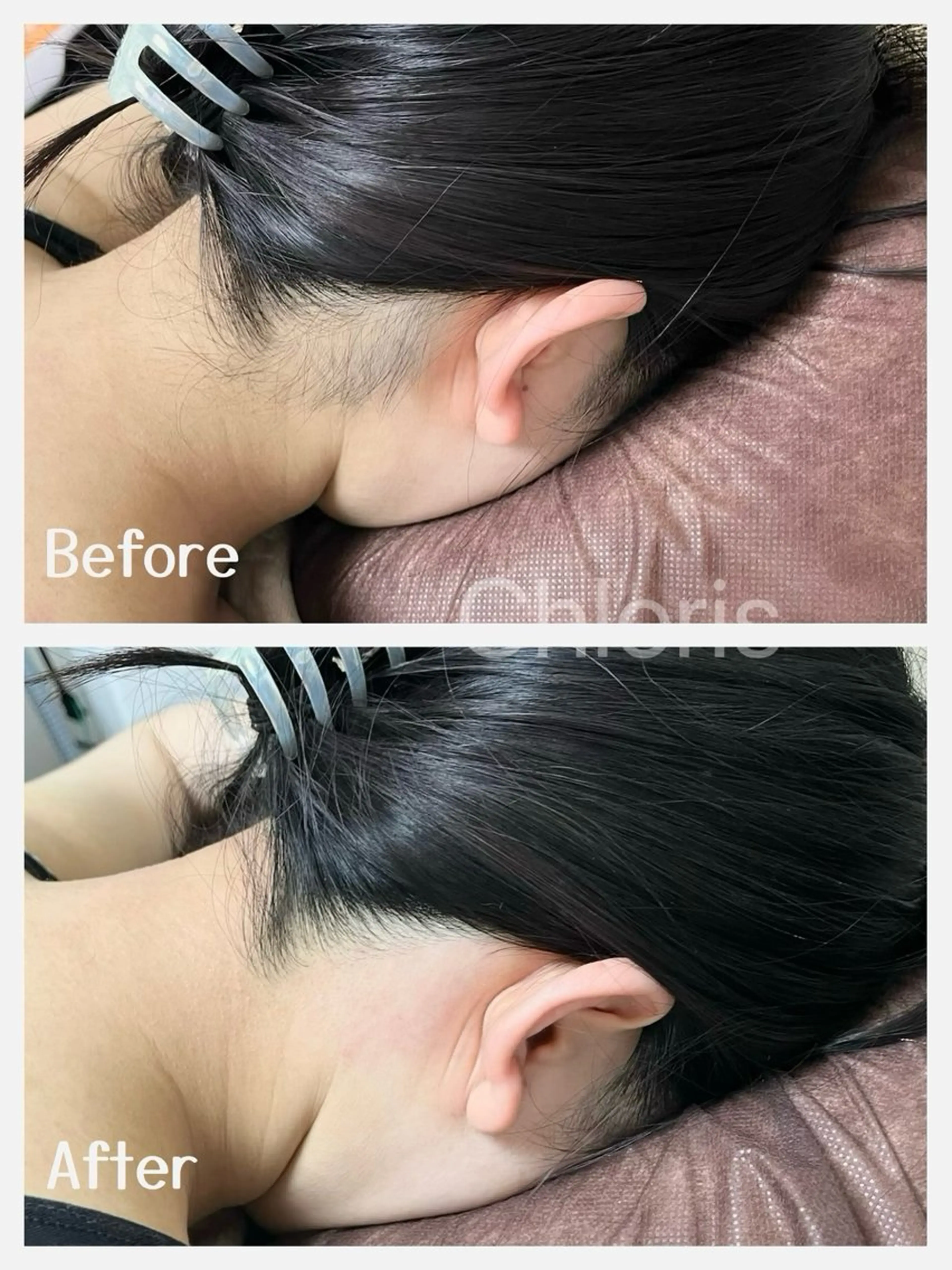 【Wax脱毛】うなじワックス脱毛の写真