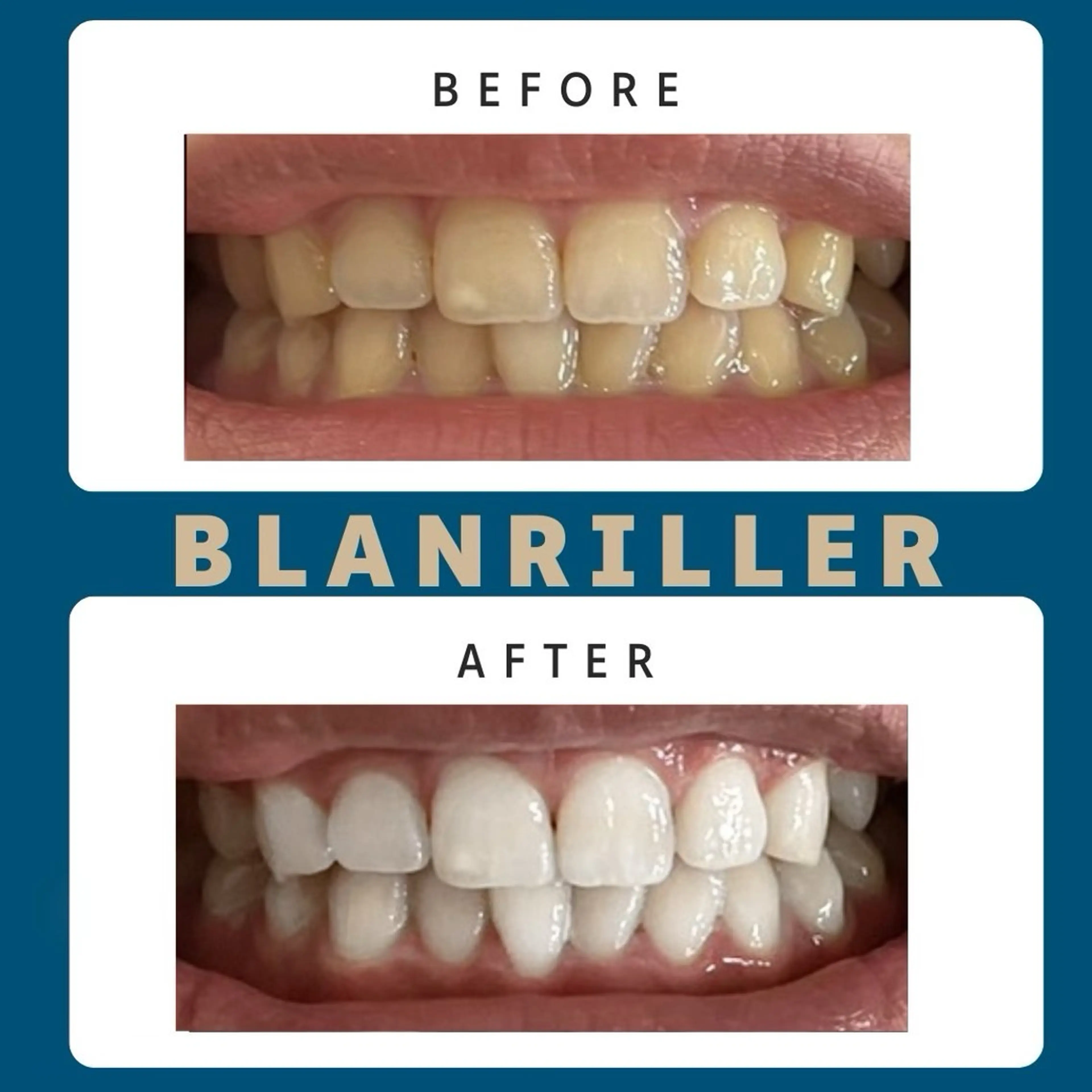 【都度払】口コミ投稿で10%オフ⭐15分×2回(30分照射)¥5000→¥4500🎶とってもお得◎ホワイトニング❤の写真