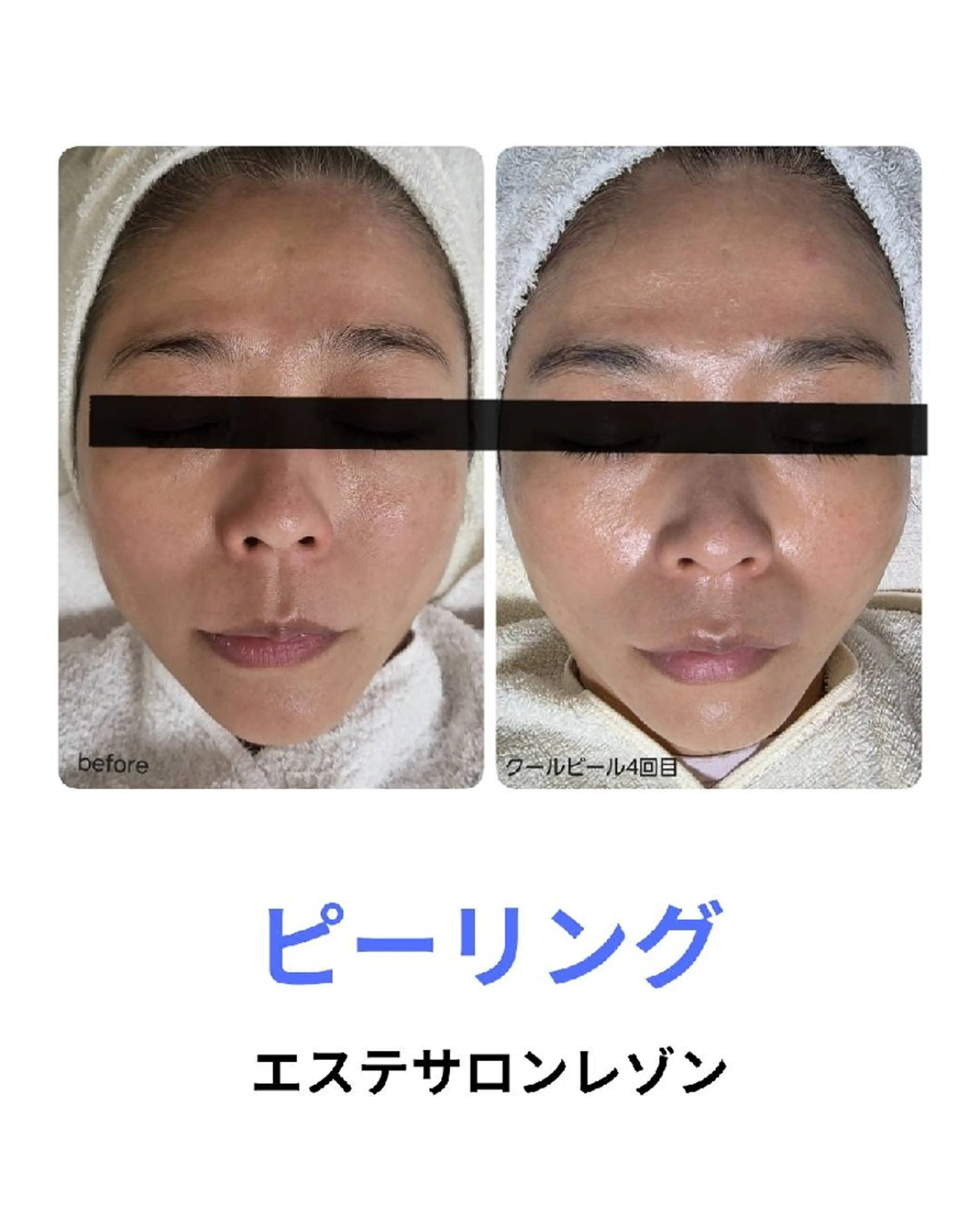 〈ニキビケアサロン〉 レゾン京橋店/ 浅川のエステ・リラクイメージ