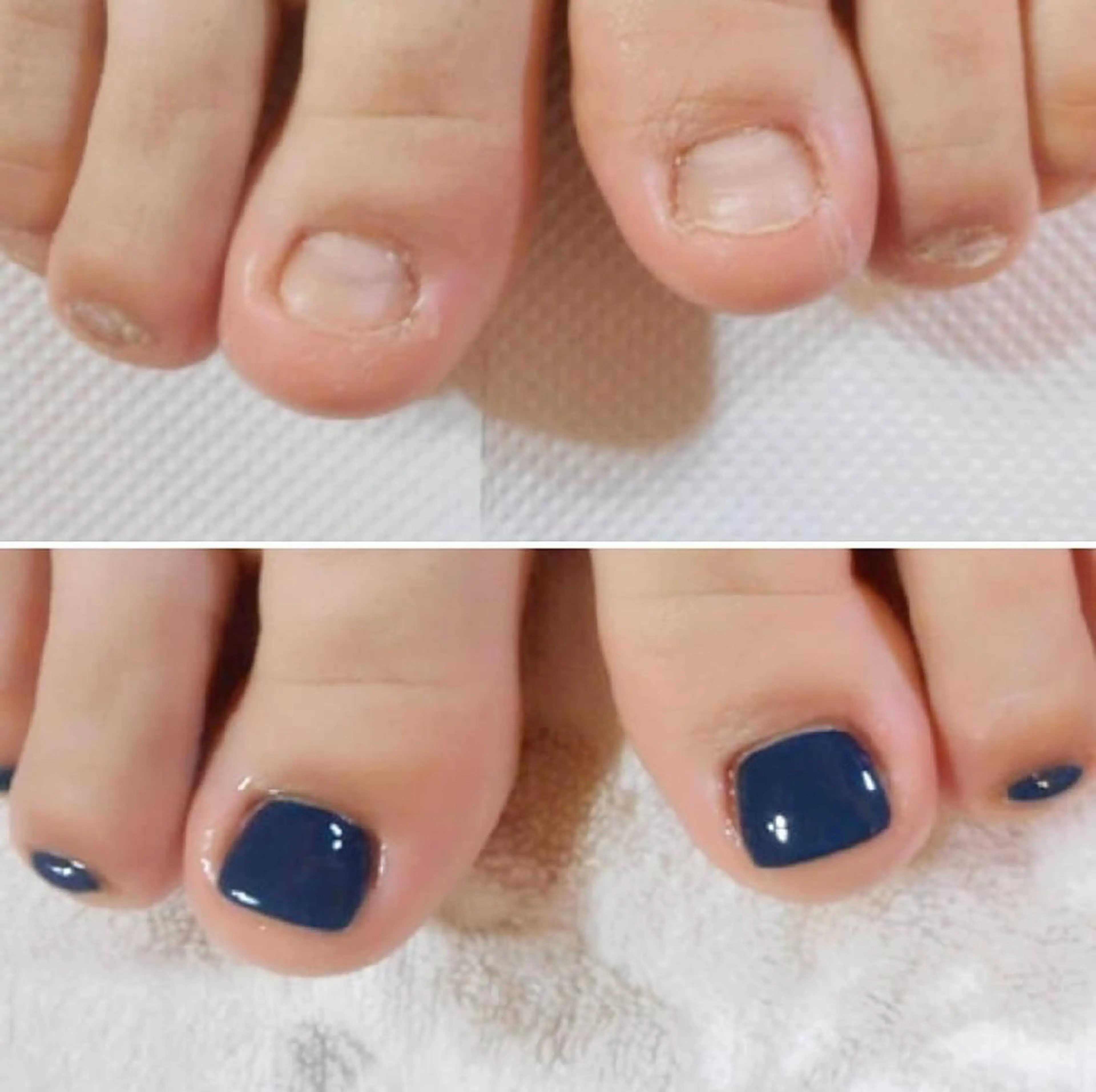 🦶【むしり癖・でこぼこ爪】🌿フット深爪矯正《ケア＋長さ出し＋ワンカラー仕上げ》の写真