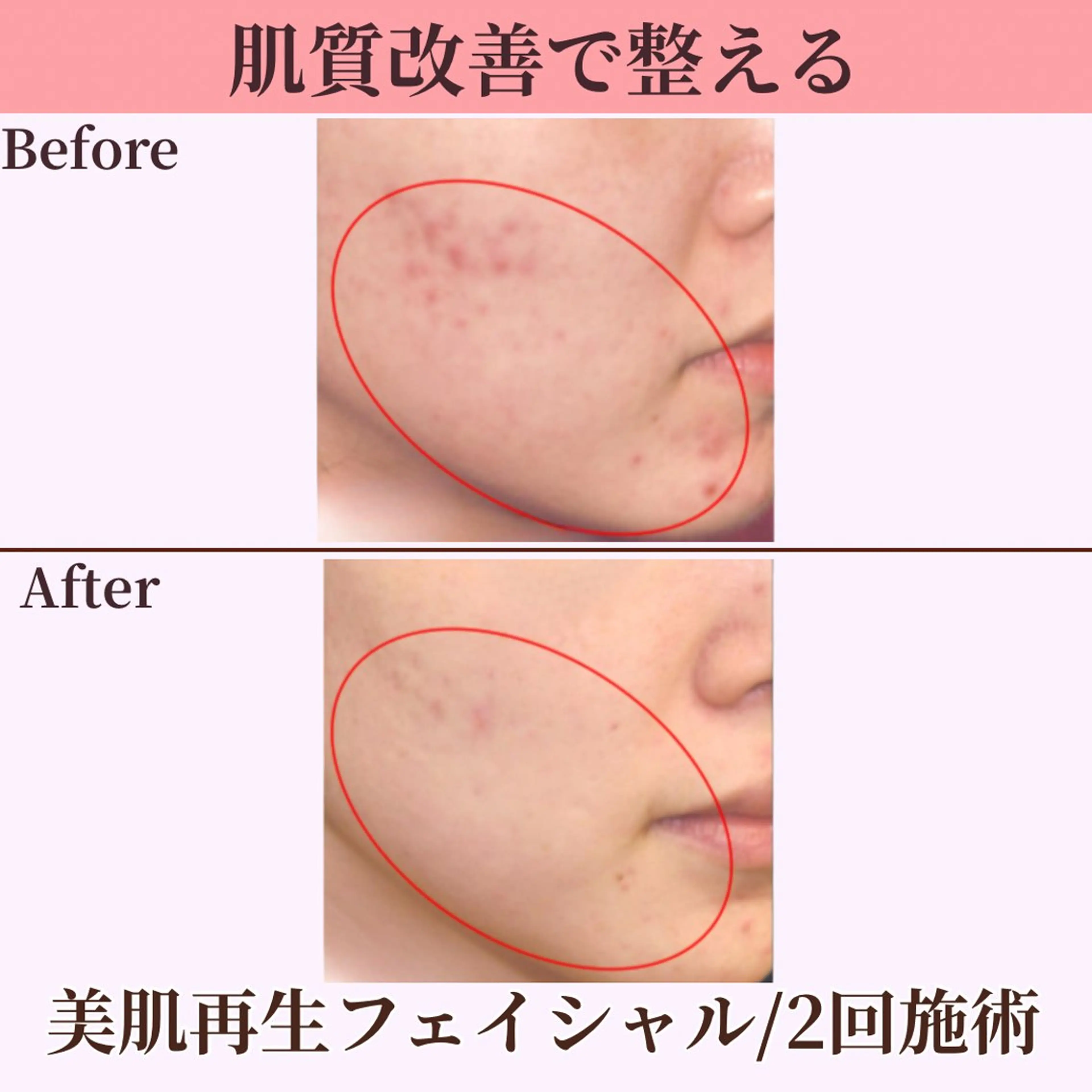 【美肌再生フェイシャル】ハリ潤いのある若々しい素肌へ♪繰り返す肌悩み/肌質改善/デコルテ付き《初回限定💫特別価格》の写真