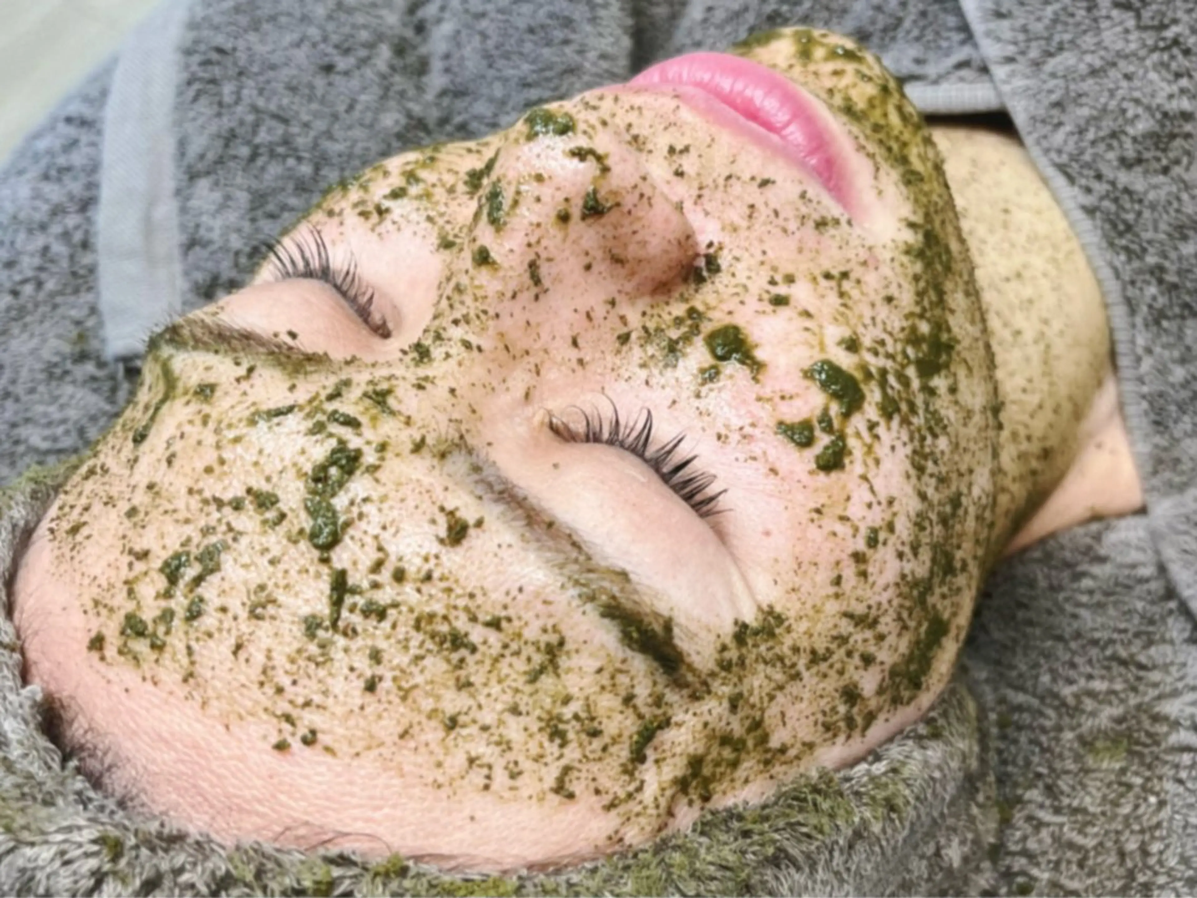 繰り返す肌荒れ・ニキビ跡に◎ハーブピーリングの写真