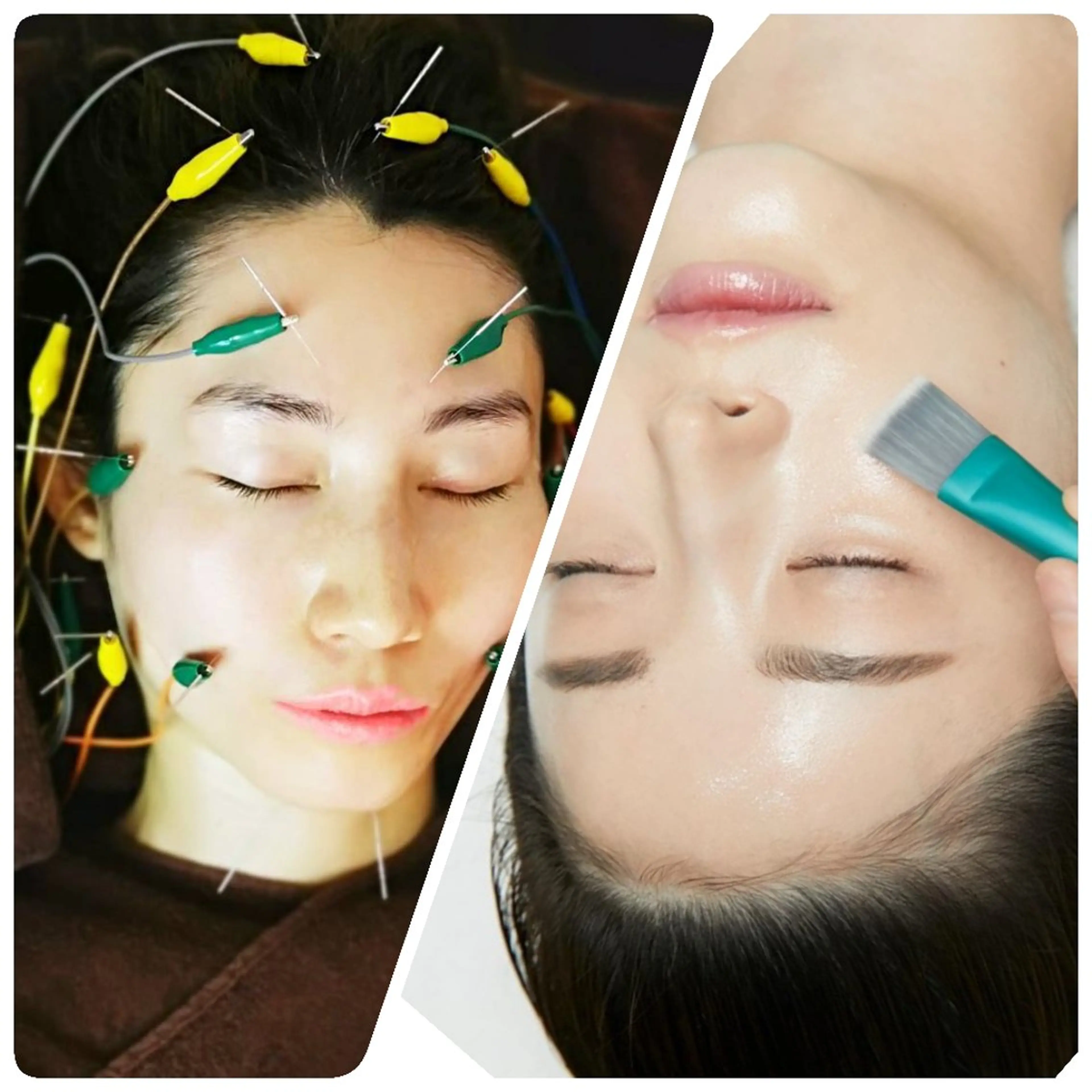 【小顔・透明感・ツヤ肌】ラミネーションピール🌈+20ヶ所電気を流す美容鍼⚡🪡【ニューハーフ鍼灸師の最強肌管理🌹】の写真