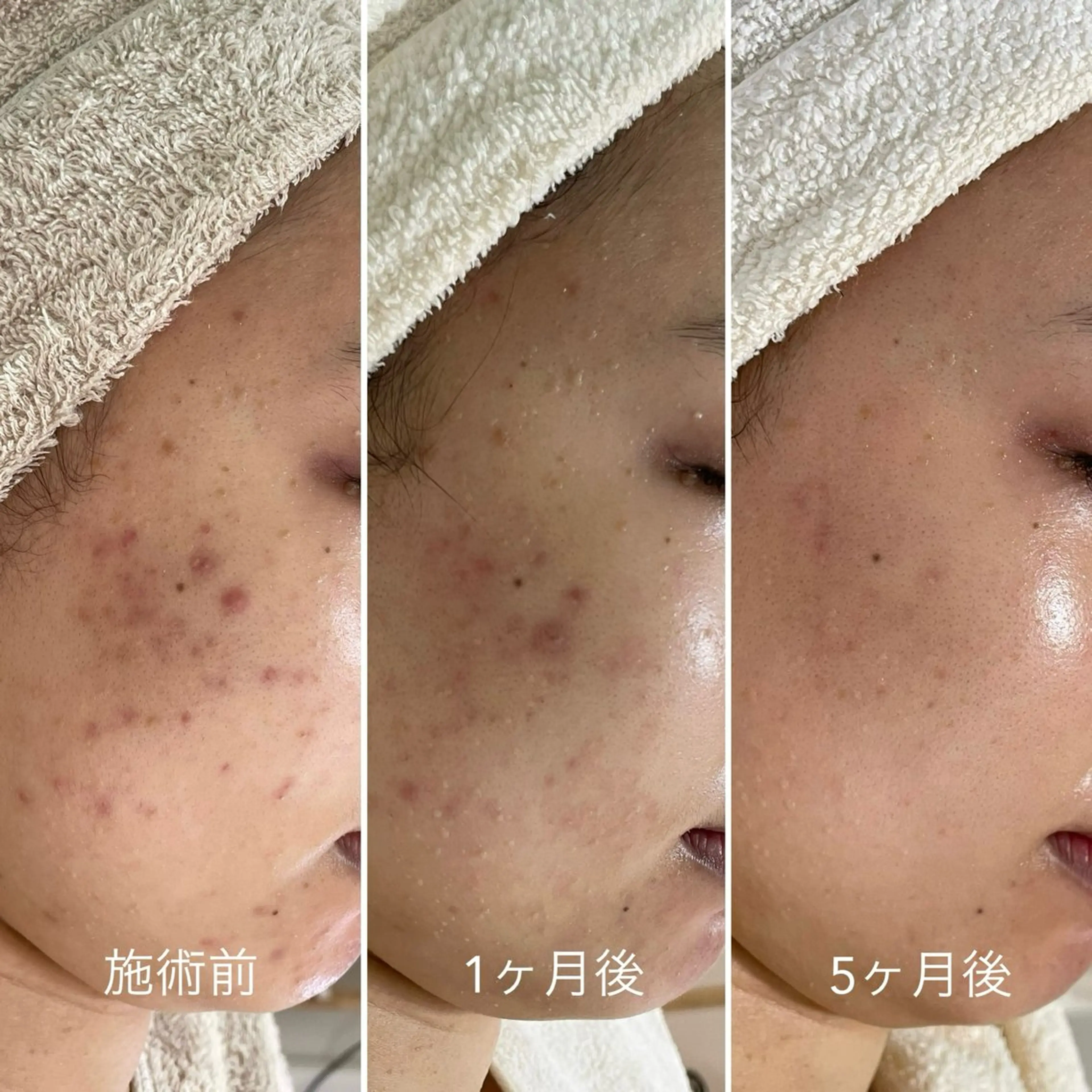 ニキビ・毛穴・ フェイシャル専門店のエステ・リラクイメージ